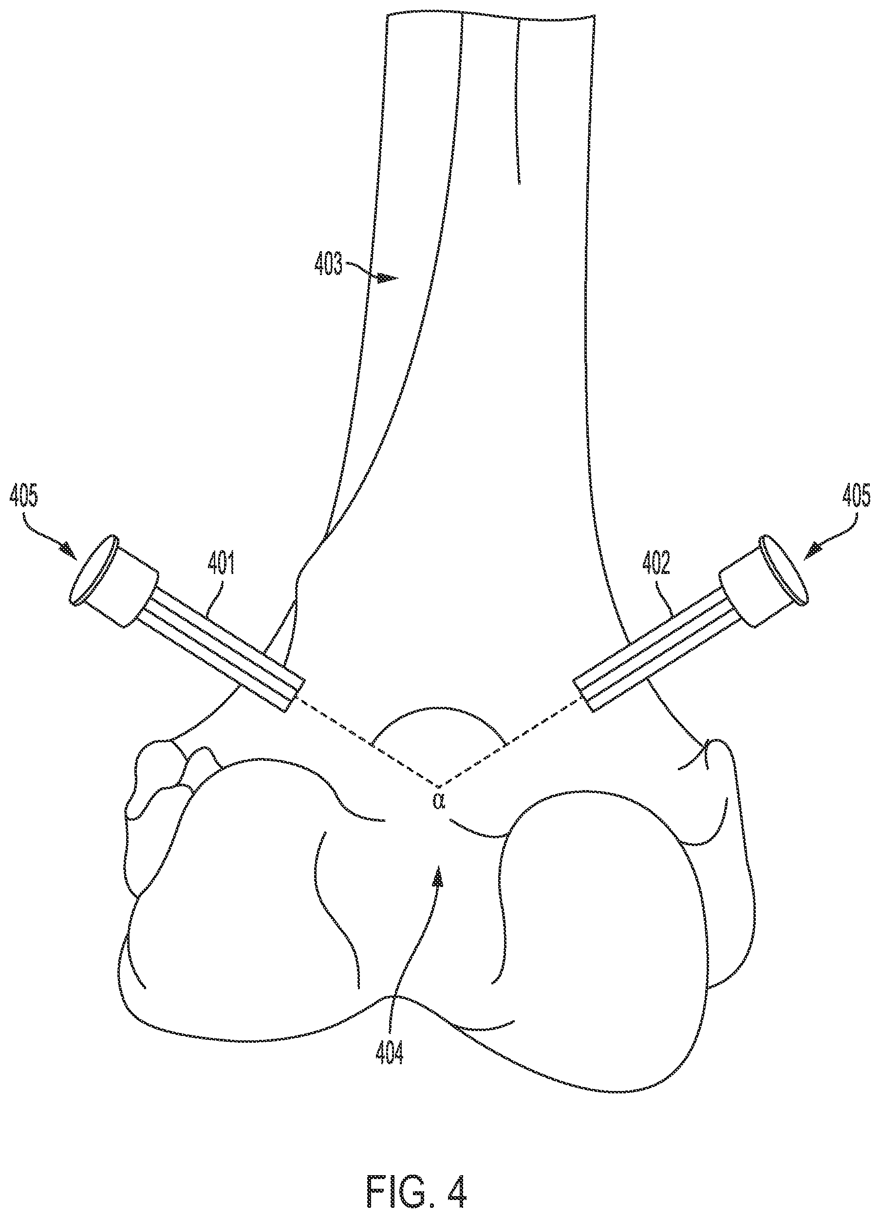 Patent US12318148 Figure 4 – Tracking device for hand tracking in surgical environment