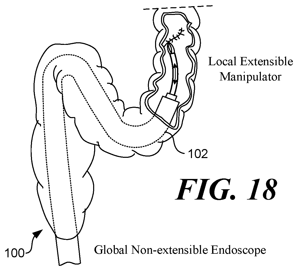 Patent US12318156 Figure 17 – Extensible continuum manipulator