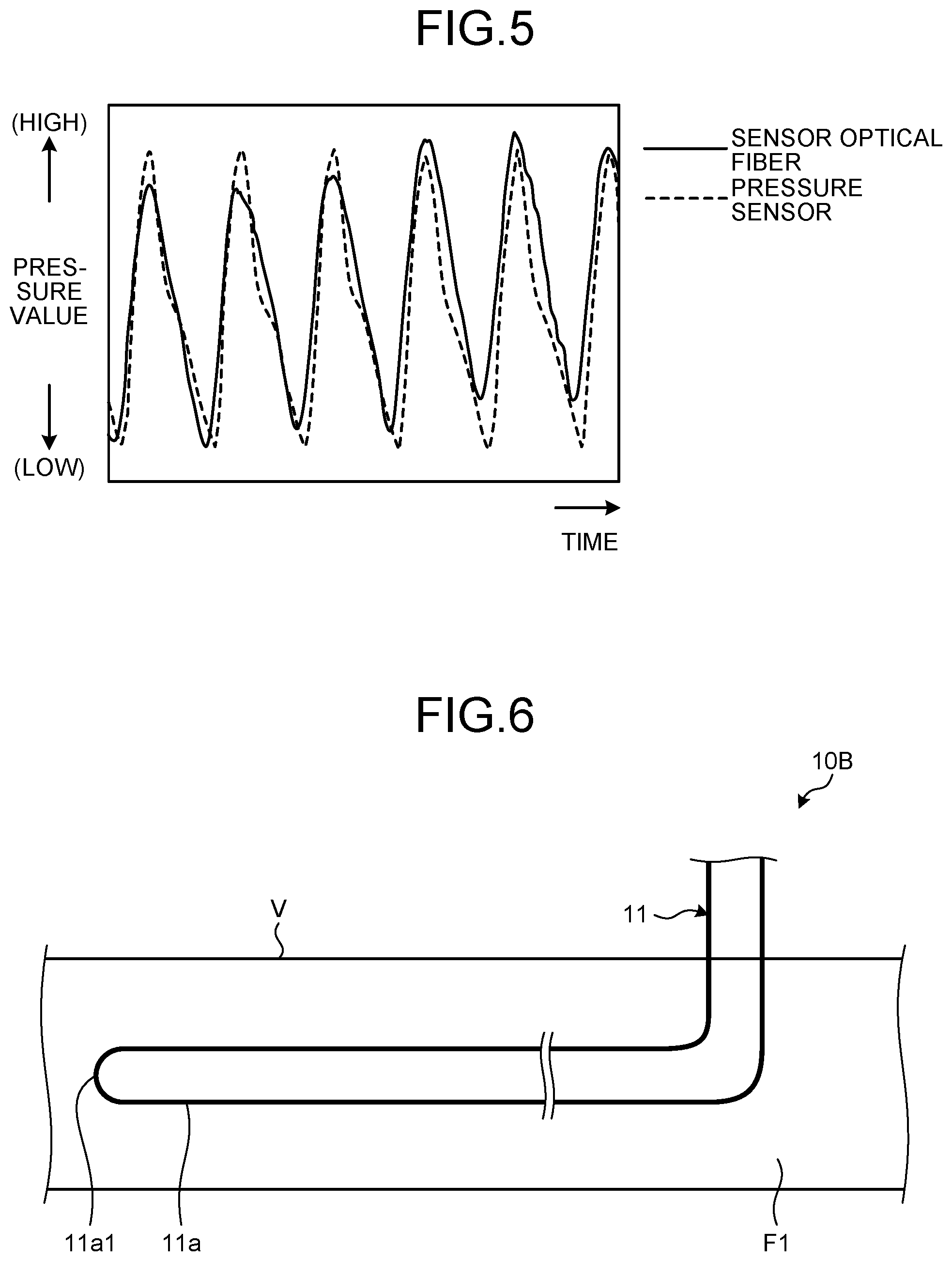 Patent US12318168 Figure 3 – In vivo pressure measurement device