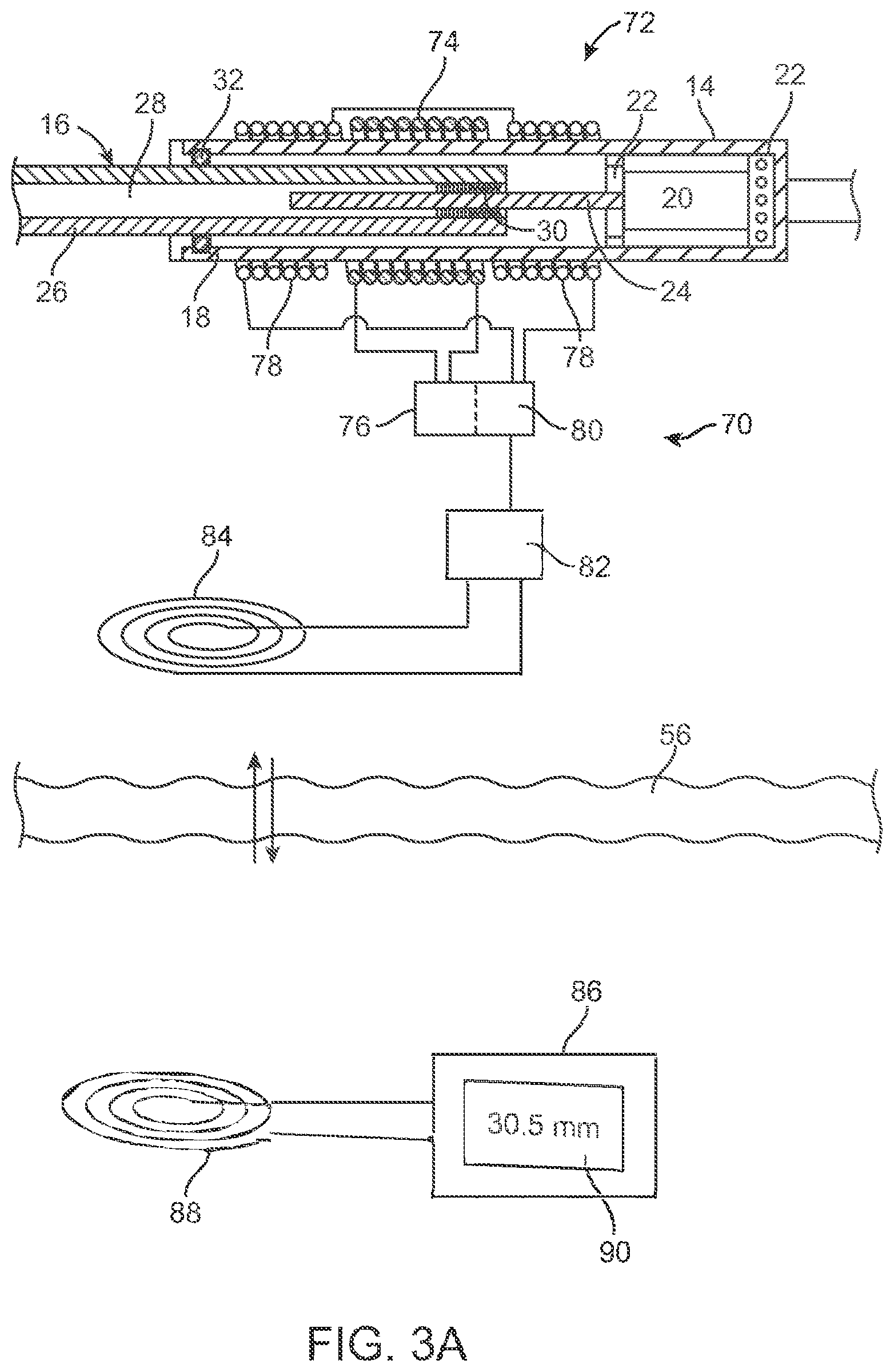 Patent US12318187 Figure 5 – Devices and methods for non-invasive implant length sensing