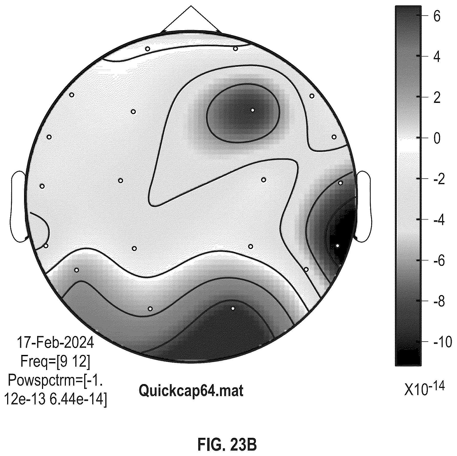 Patent US12318206 Figure 18 – Blood glucose states based on sensed brain activity