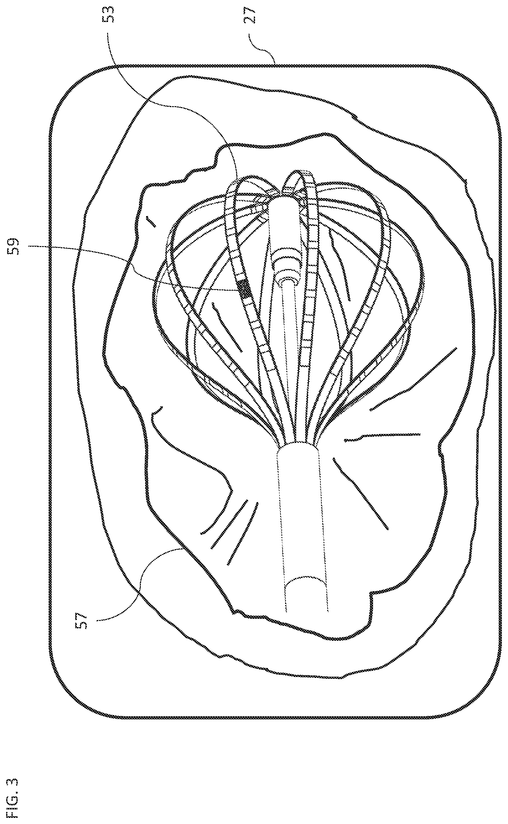 Patent US12318207 Figure 3 – Transient event identification