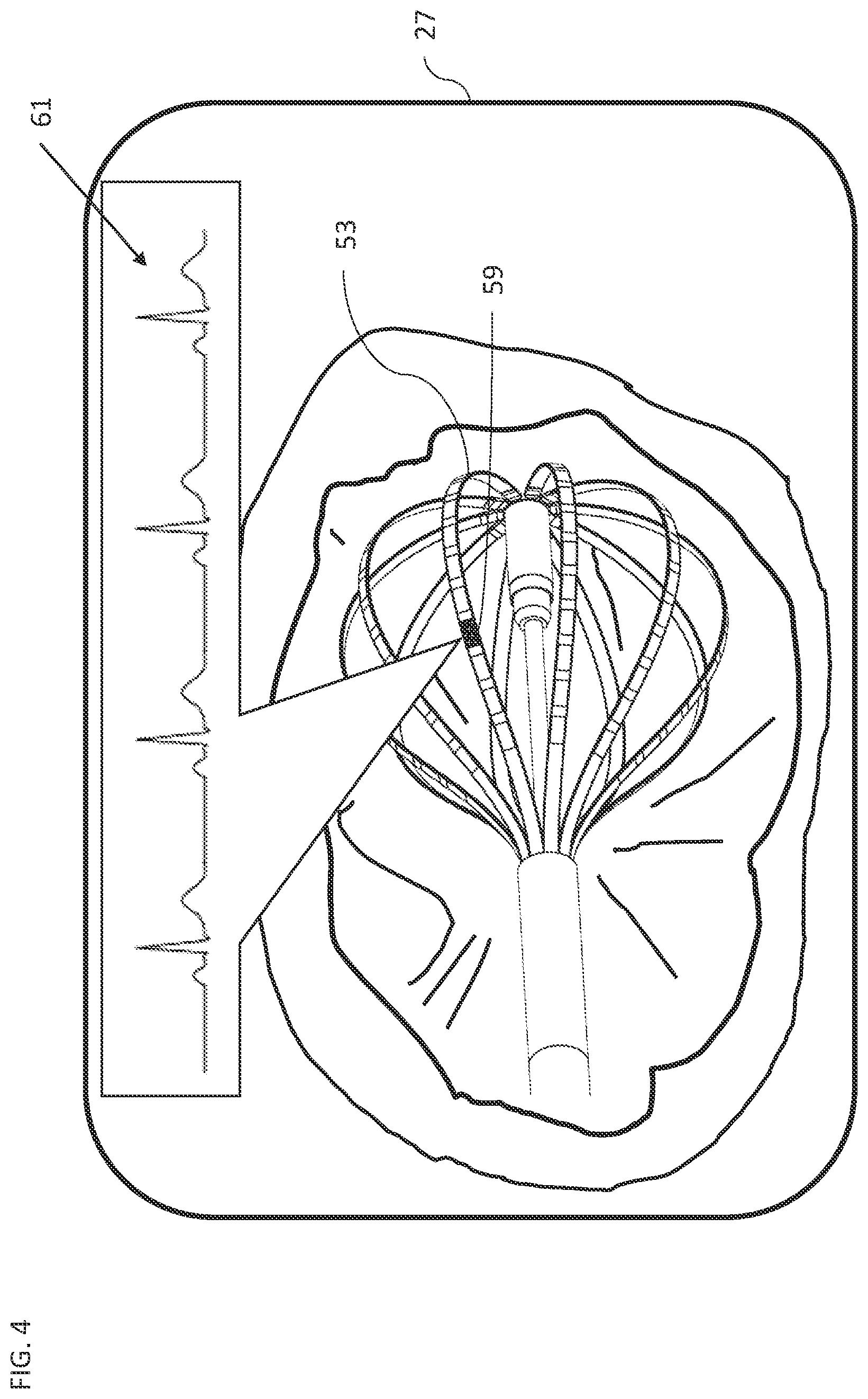 Patent US12318207 Figure 4 – Transient event identification
