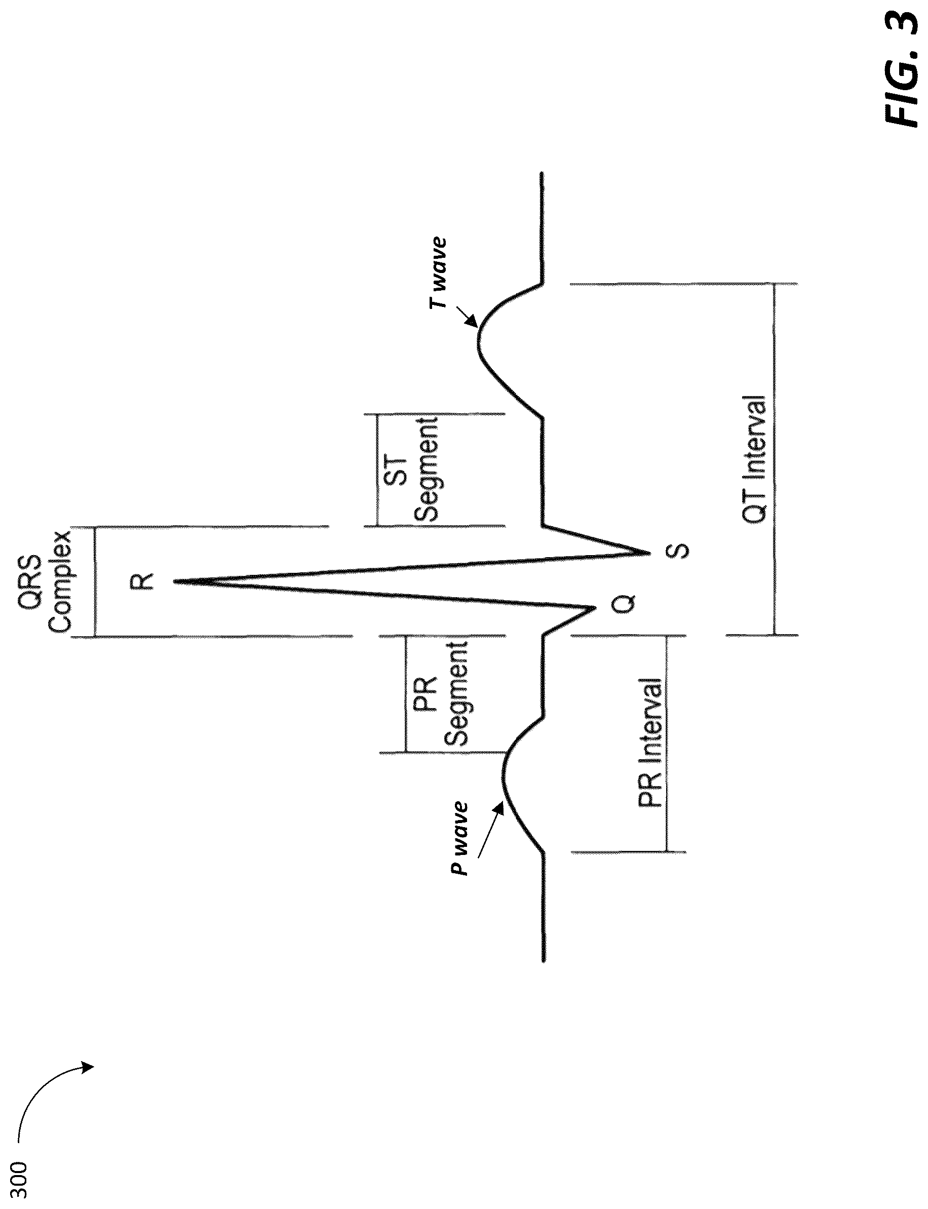 Patent US12318208 Figure 3 – Two-lead QT interval prediction