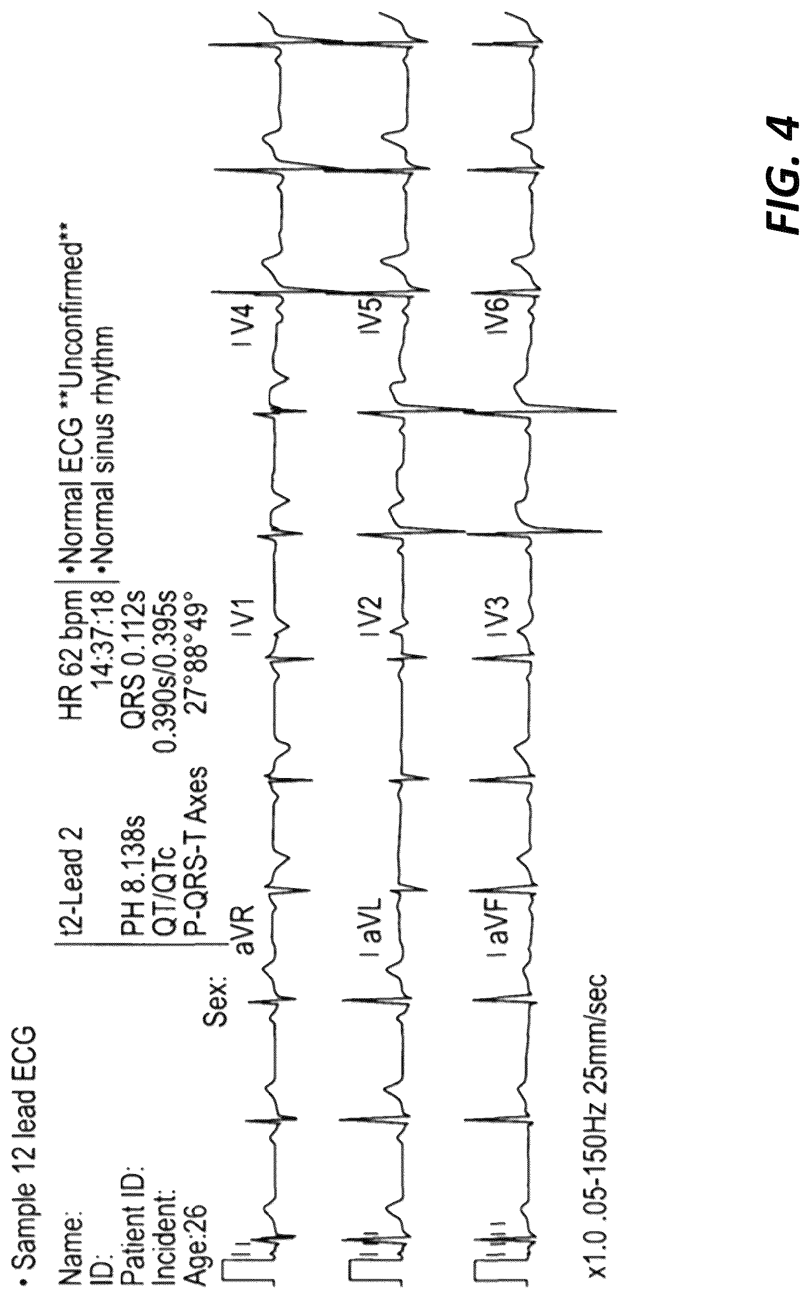 Patent US12318208 Figure 4 – Two-lead QT interval prediction