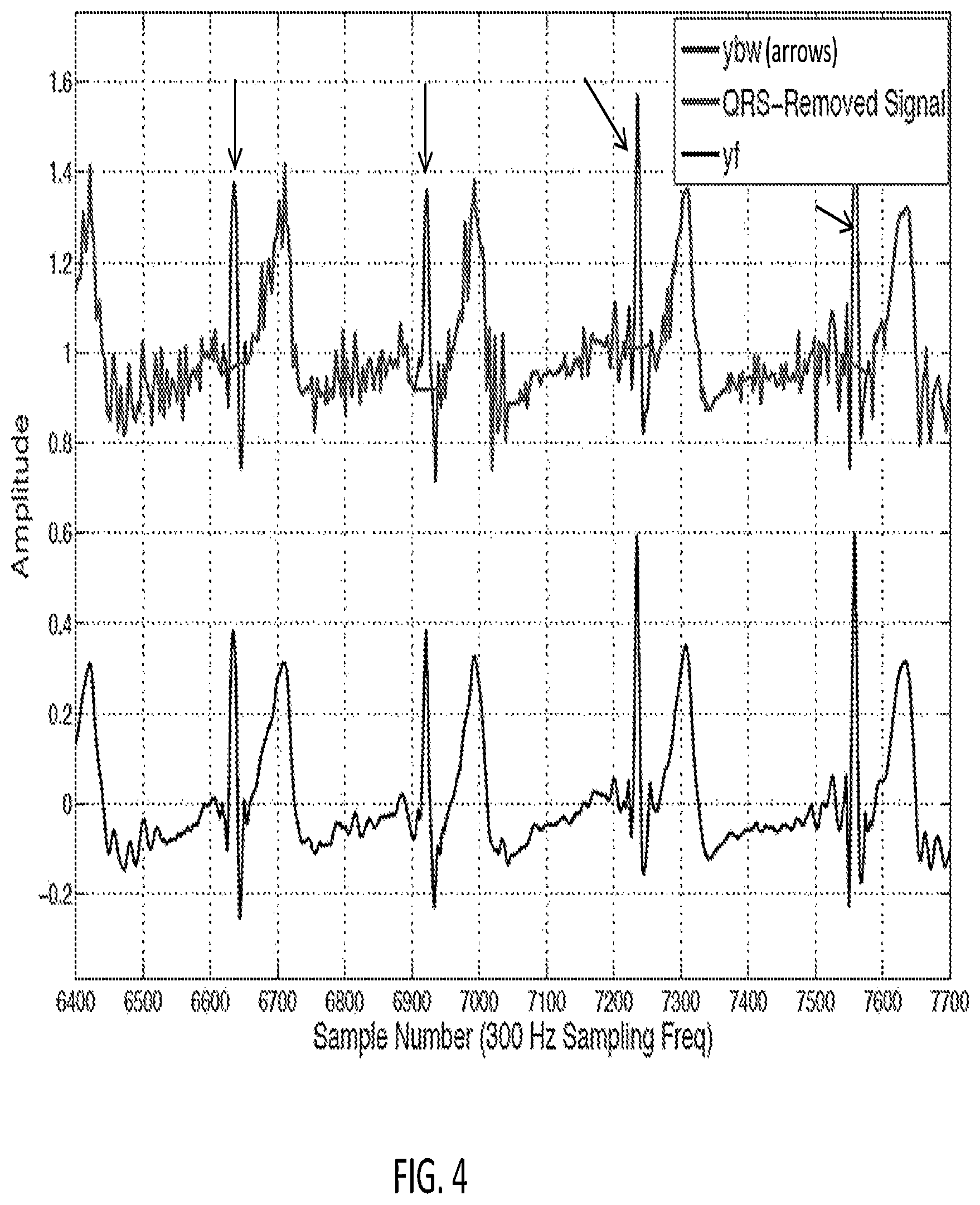 Patent US12318209 Figure 4 – Electrocardiogram signal detection