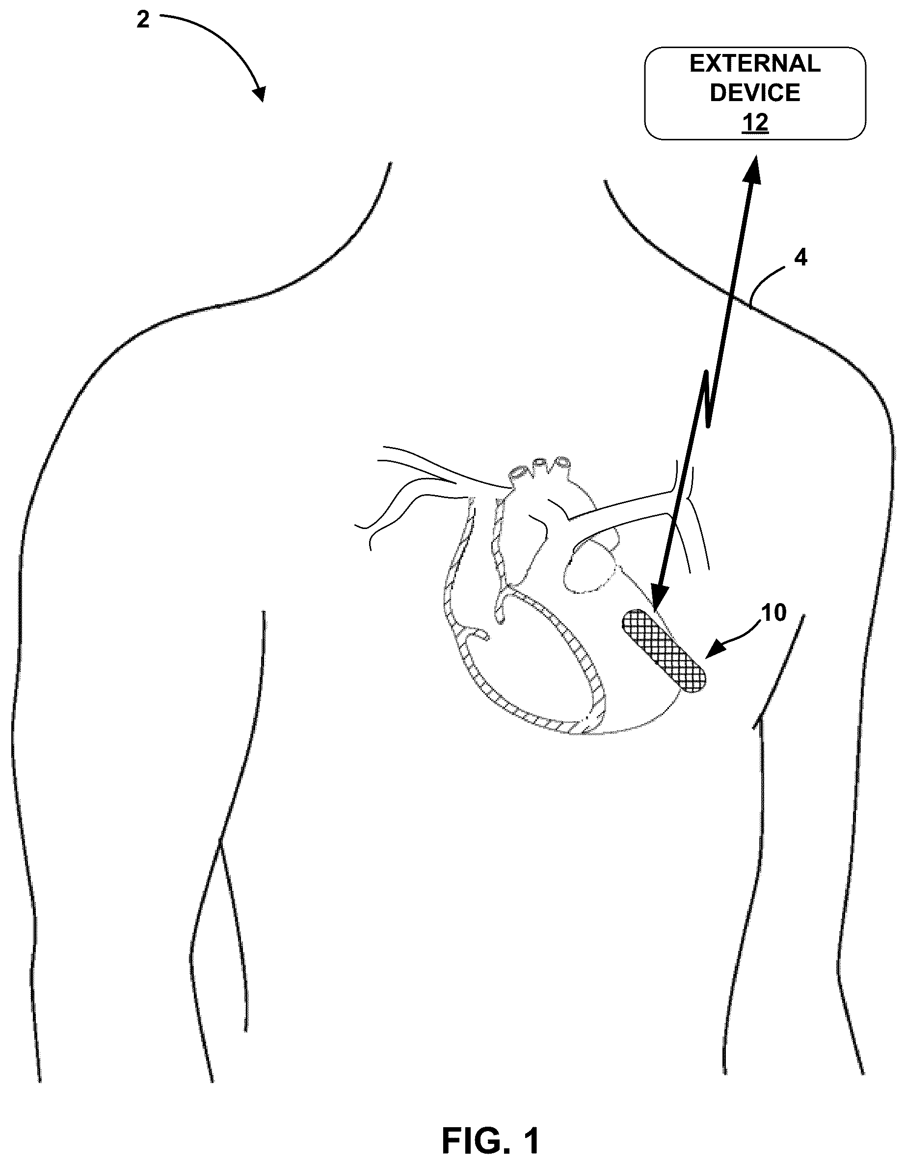 Patent US12318210 Figure 1 – Premature ventricular contraction (PVC) detection