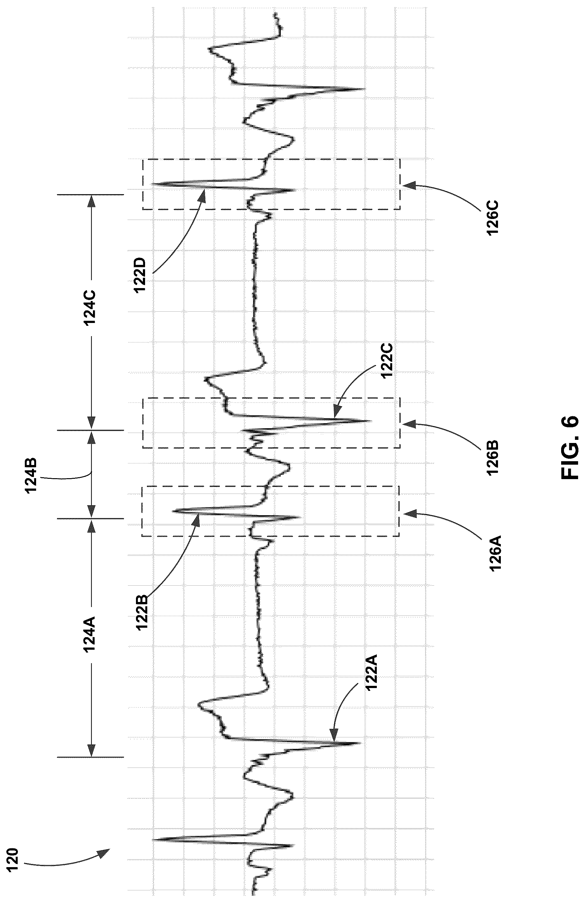 Patent US12318210 Figure 6 – Premature ventricular contraction (PVC) detection