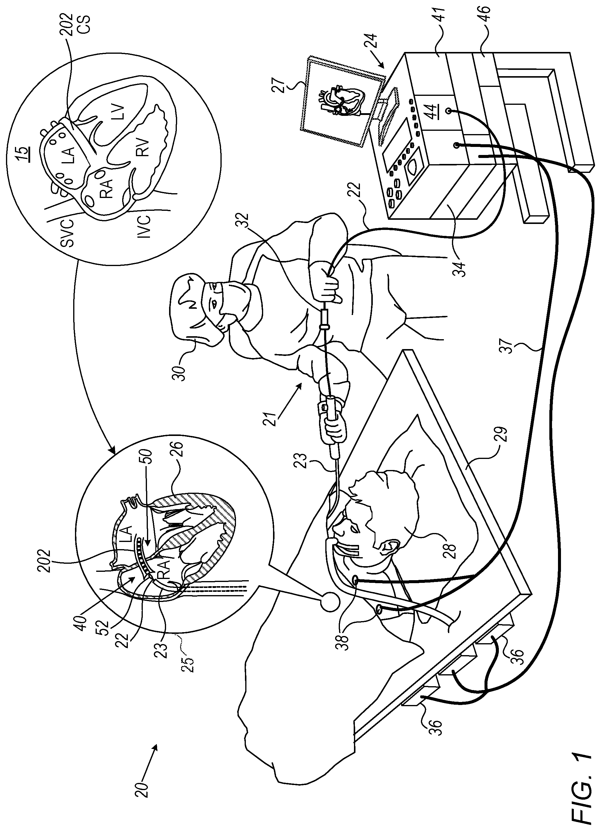 Patent US12318211 Figure 1 – Location-based pattern matching of coronary sinus (CS) signals