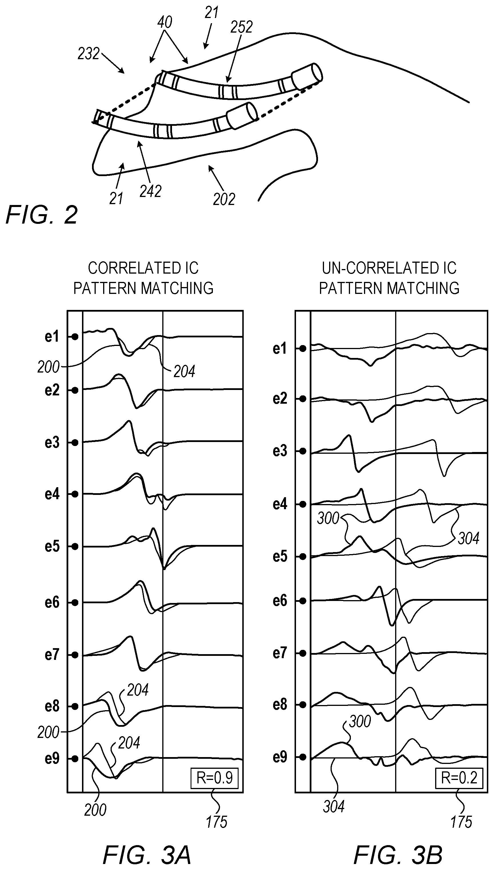 Patent US12318211 Figure 2 – Location-based pattern matching of coronary sinus (CS) signals