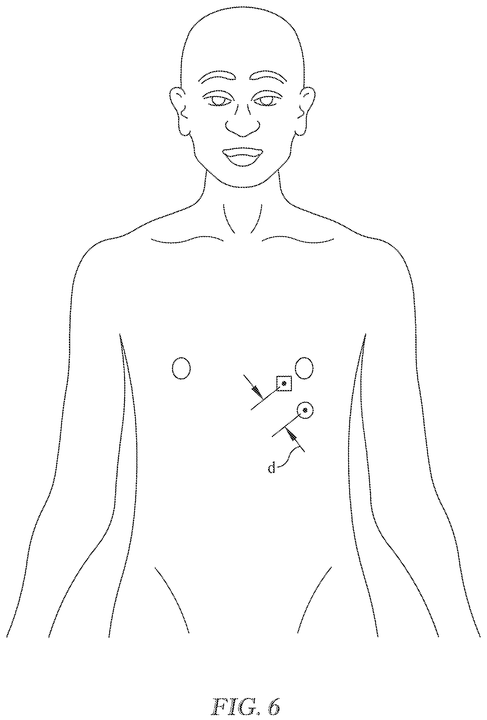 Patent US12318222 Figure 6 – Method and apparatus for accurate placement of electrocardiogram electrodes