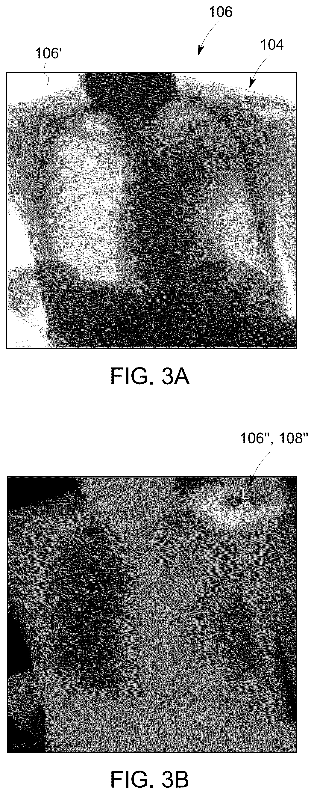 Patent US12318239 Figure 3 – X-ray lead marker detection system for x-ray imaging system
