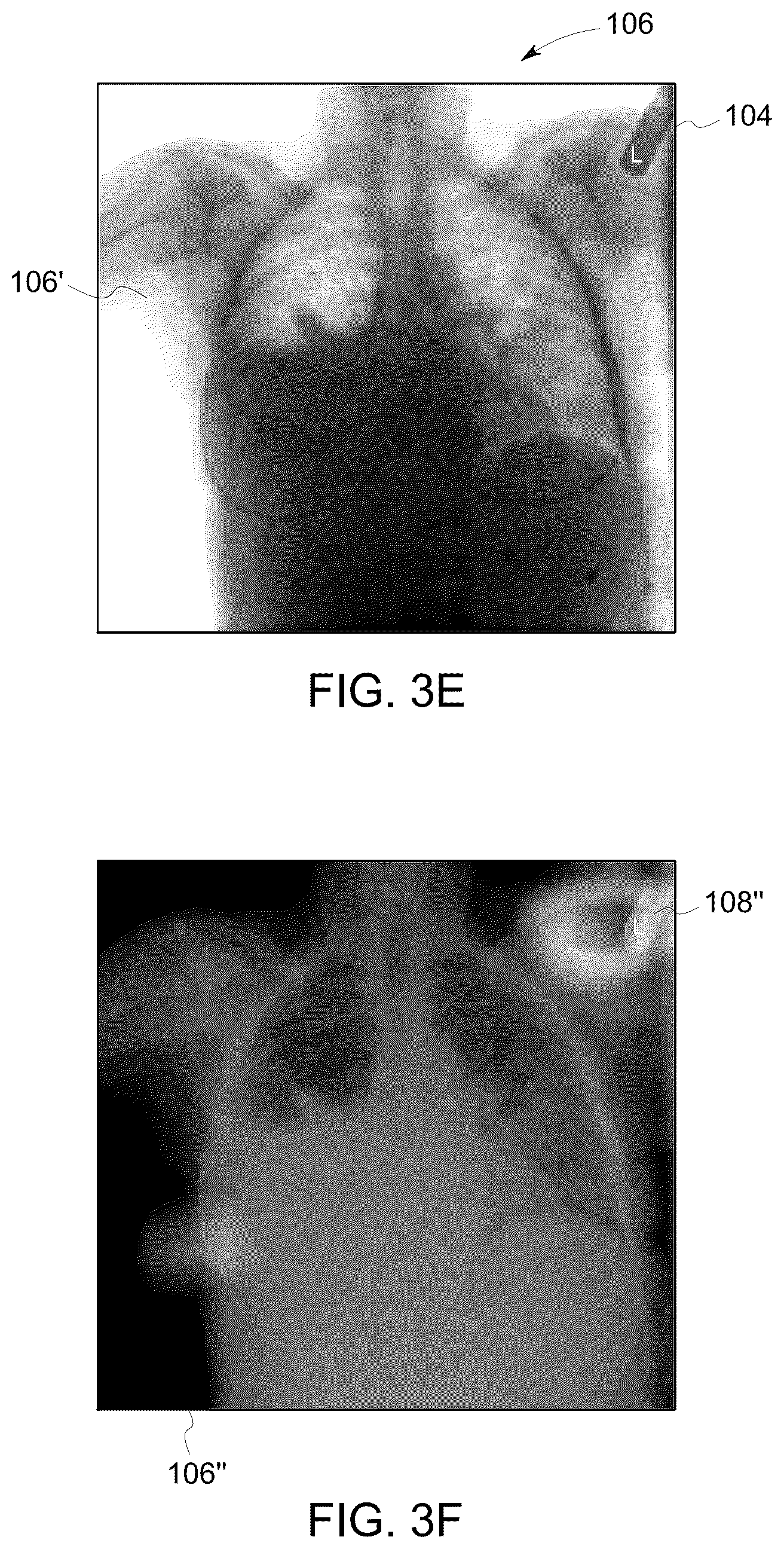 Patent US12318239 Figure 5 – X-ray lead marker detection system for x-ray imaging system
