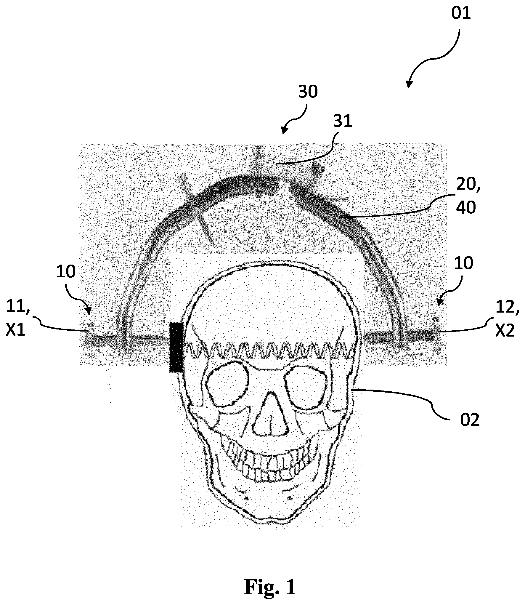 Patent US12318242 Figure 1 – Method and device for a non-invasive determination and/or monitoring of intracranial compliance