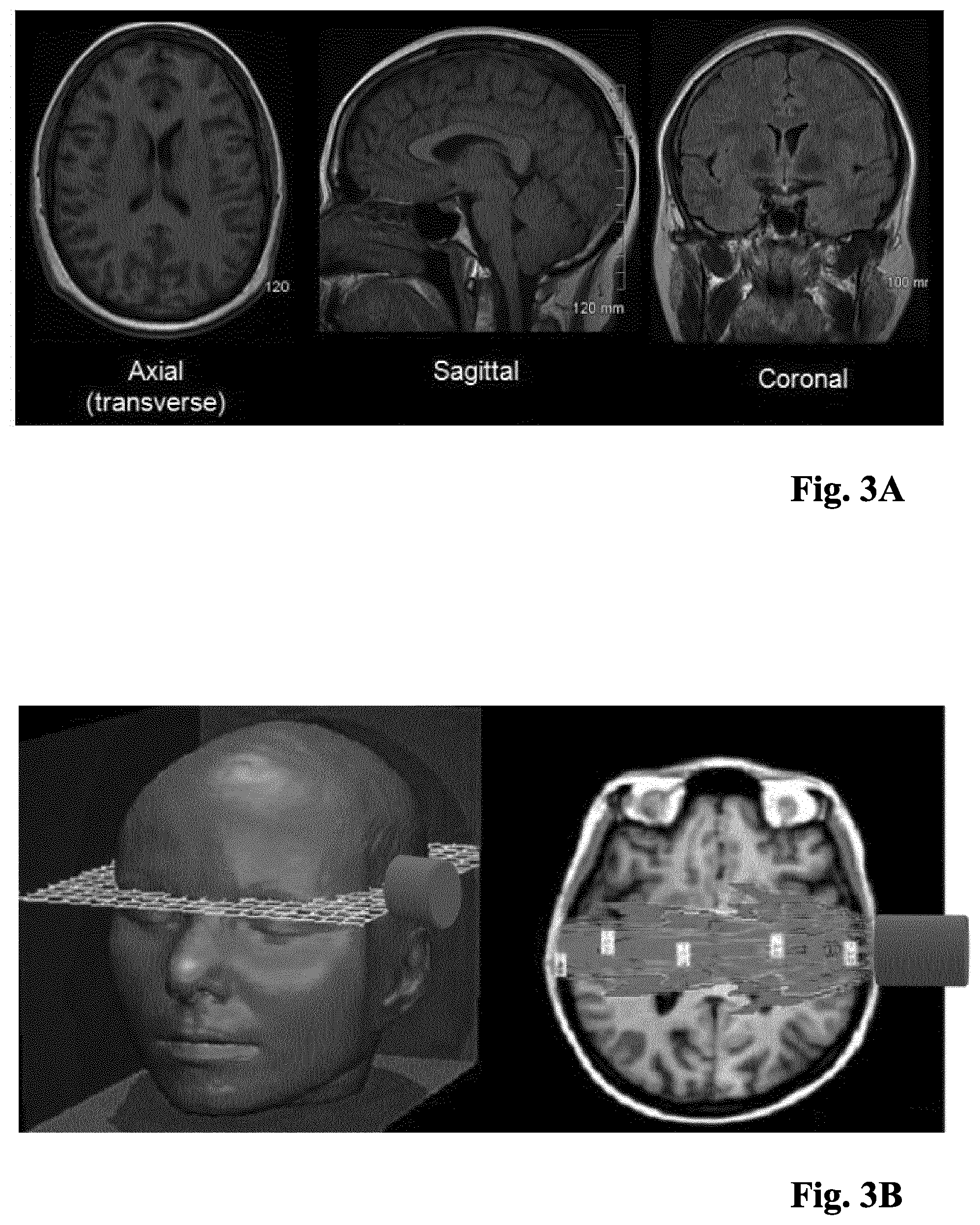 Patent US12318242 Figure 3 – Method and device for a non-invasive determination and/or monitoring of intracranial compliance