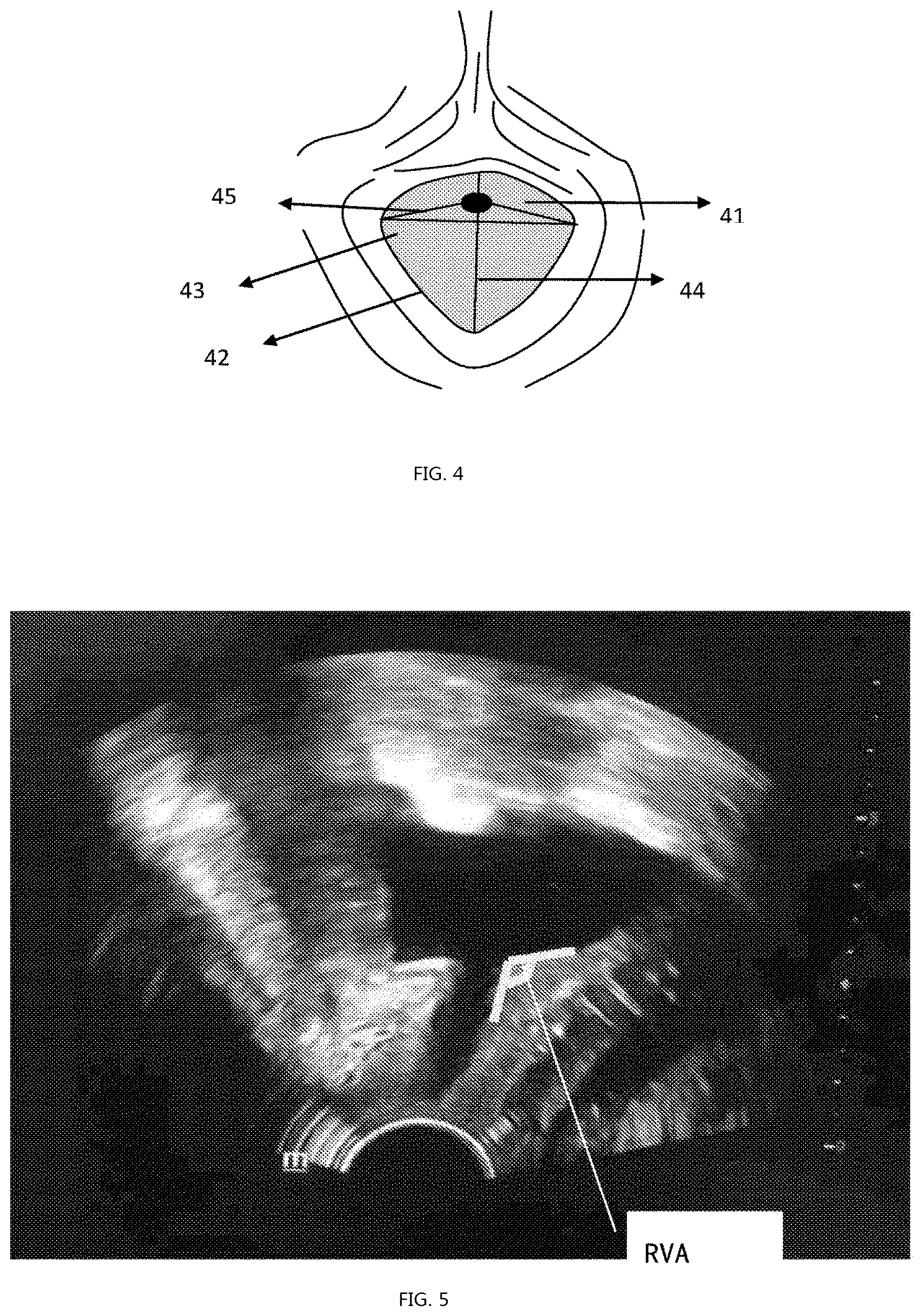 Patent US12318246 Figure 3 – Method for measuring parameters in ultrasonic image and ultrasonic imaging system