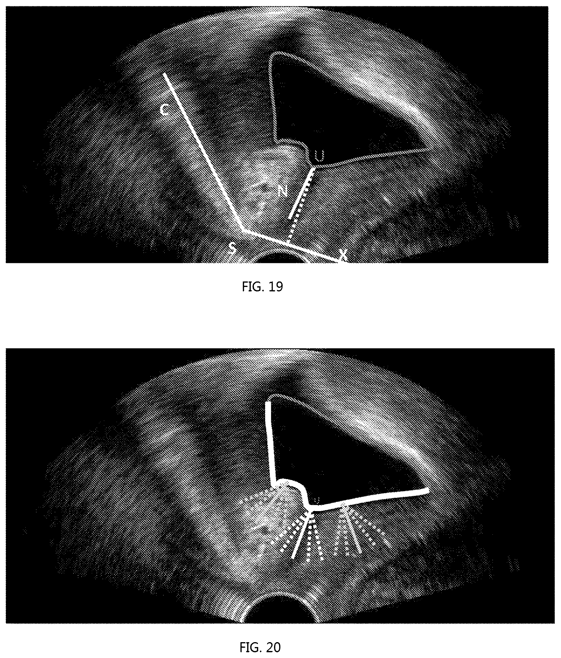 Patent US12318246 Figure 9 – Method for measuring parameters in ultrasonic image and ultrasonic imaging system