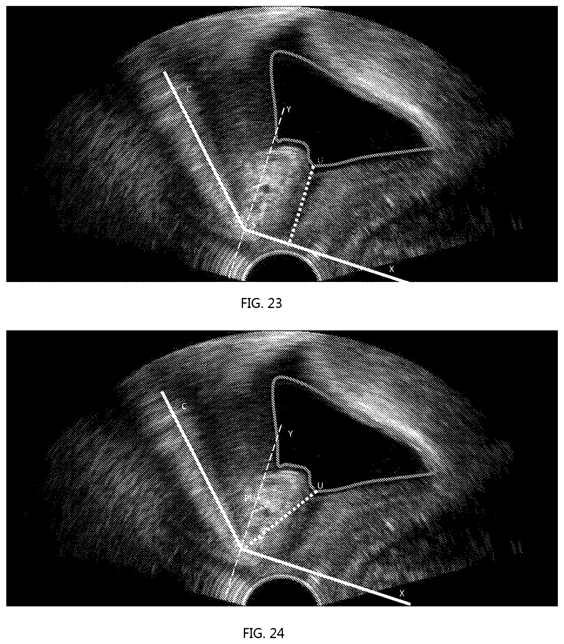 Patent US12318246 Figure 11 – Method for measuring parameters in ultrasonic image and ultrasonic imaging system