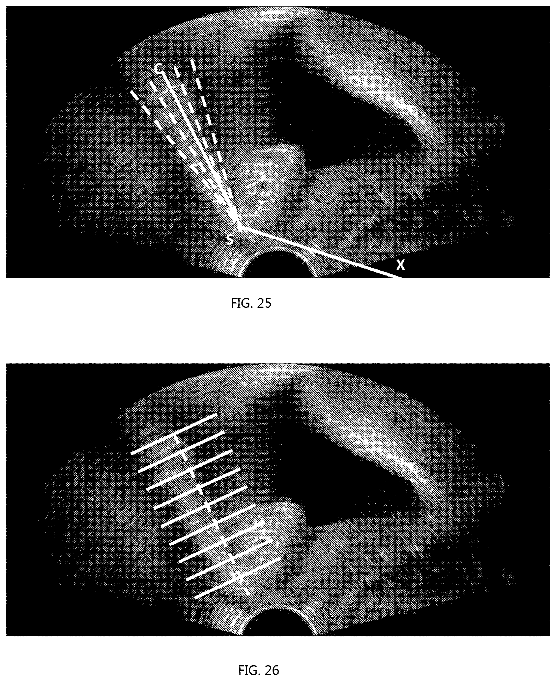Patent US12318246 Figure 12 – Method for measuring parameters in ultrasonic image and ultrasonic imaging system