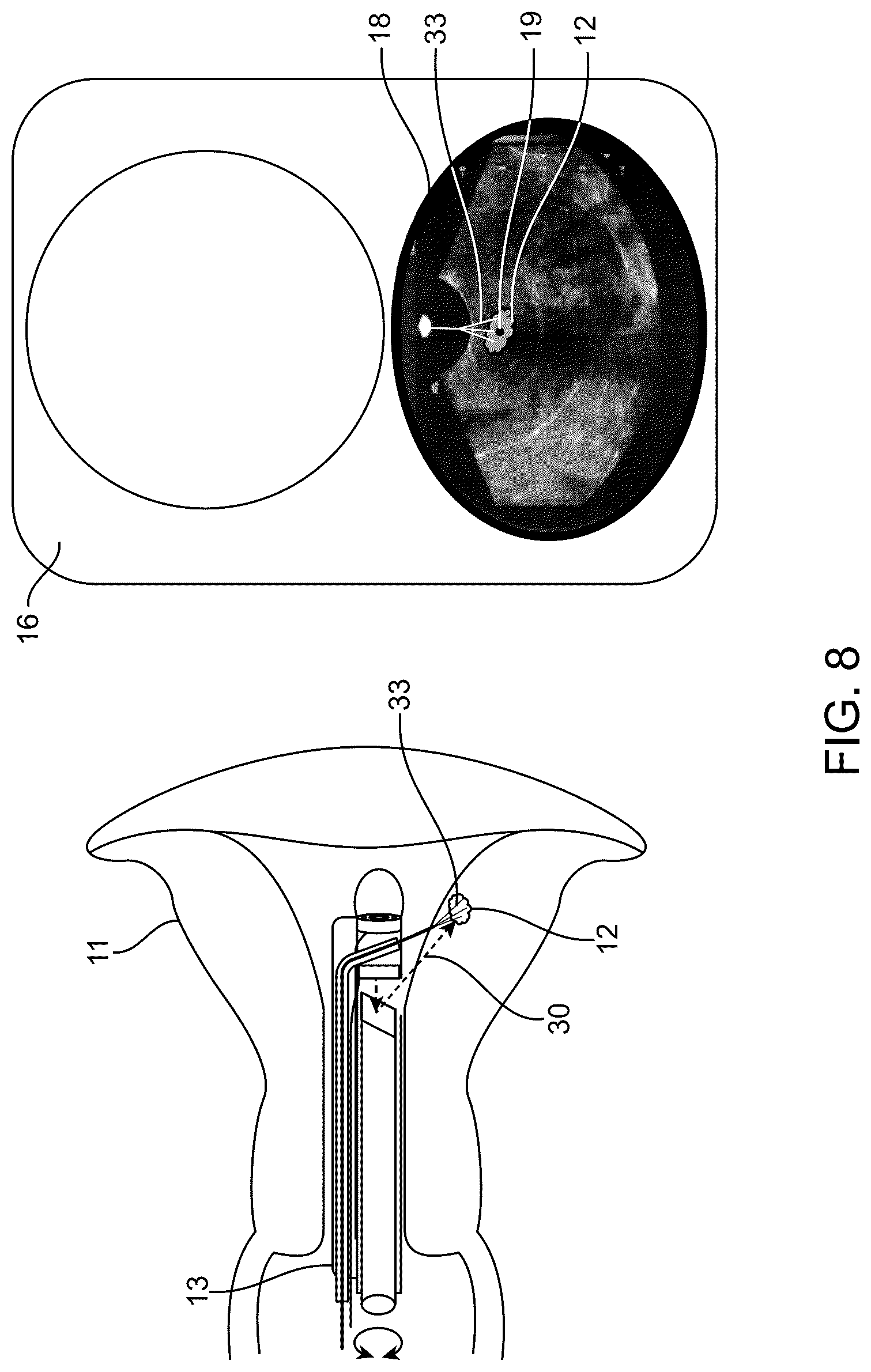 Patent US12318252 Figure 8 – Combined ultrasonic and direct visual hysteroscope