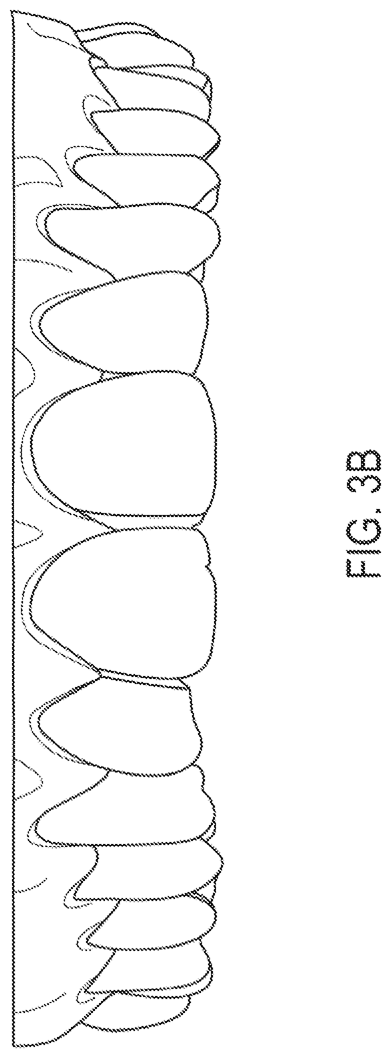 Patent US12318260 Figure 10 – Assembly for locating and verifying the anatomic position of a full-arch dental prosthetics