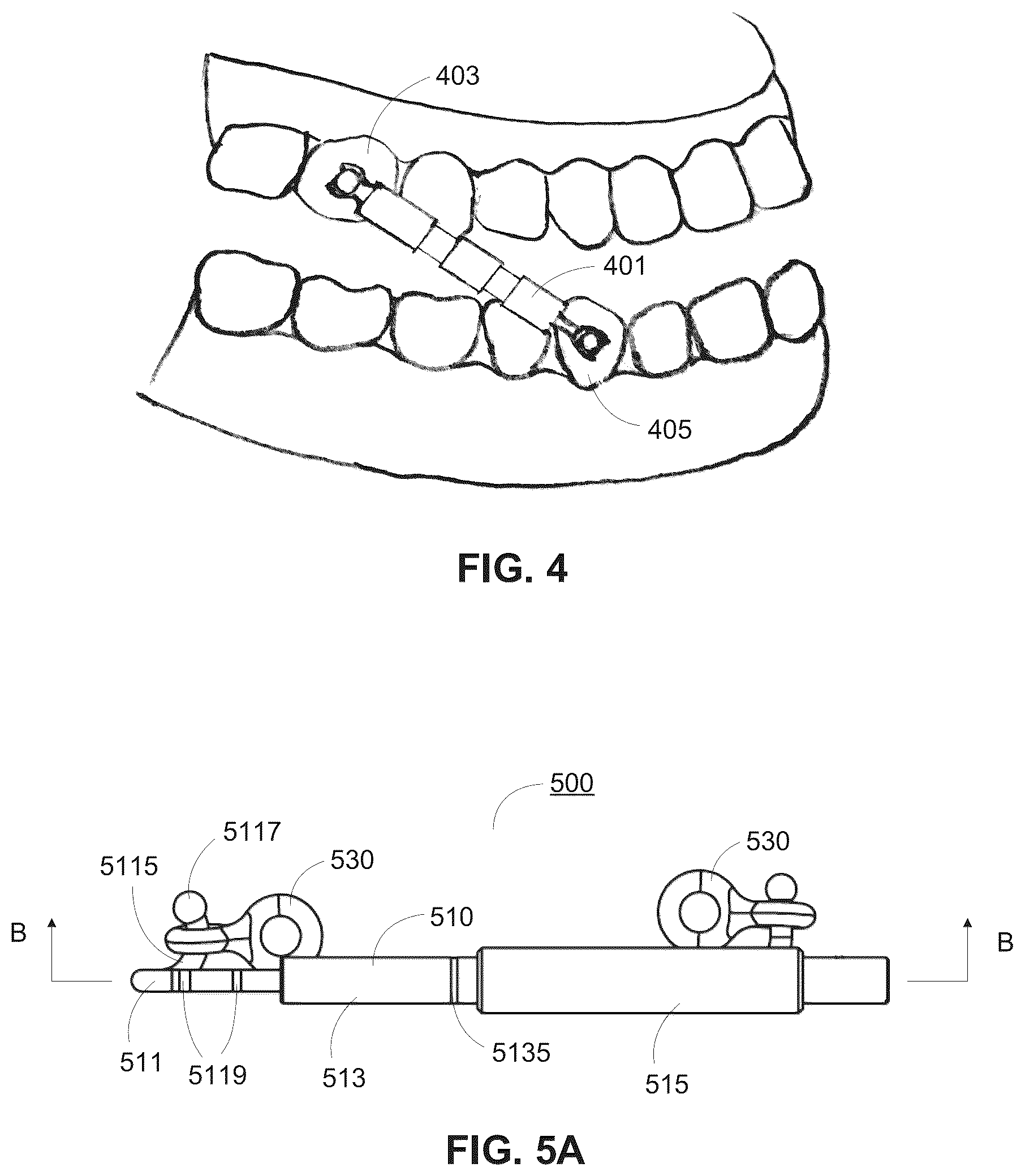 Patent US12318262 Figure 3 – Force applying device for orthodontic treatment