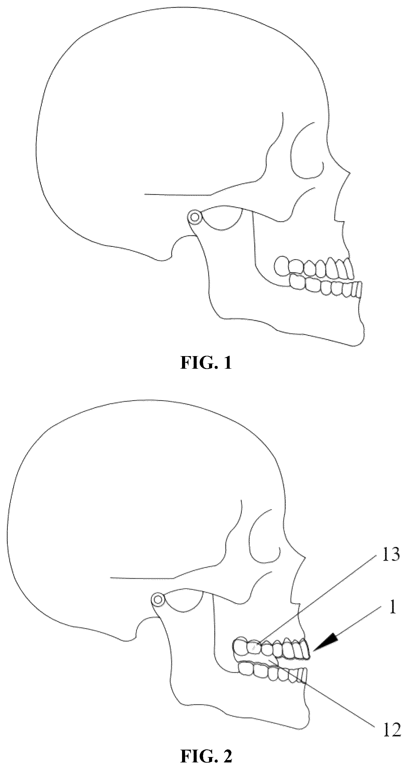 Patent US12318263 Figure 1 – Mandibular positioning facial retrognathism orthodontic system and design method thereof