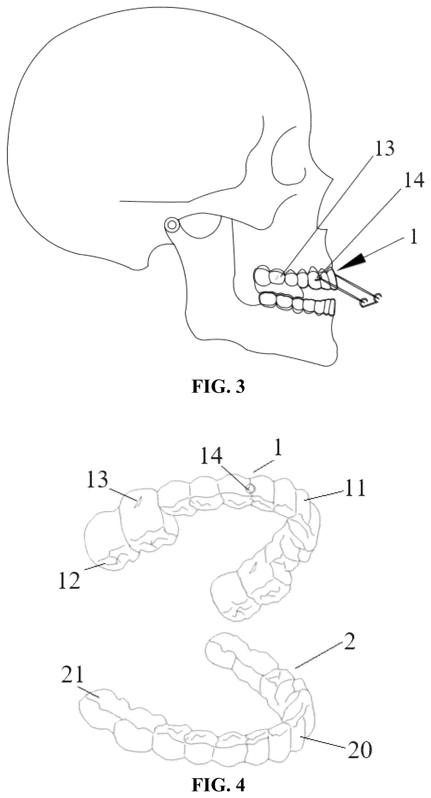 Patent US12318263 Figure 2 – Mandibular positioning facial retrognathism orthodontic system and design method thereof