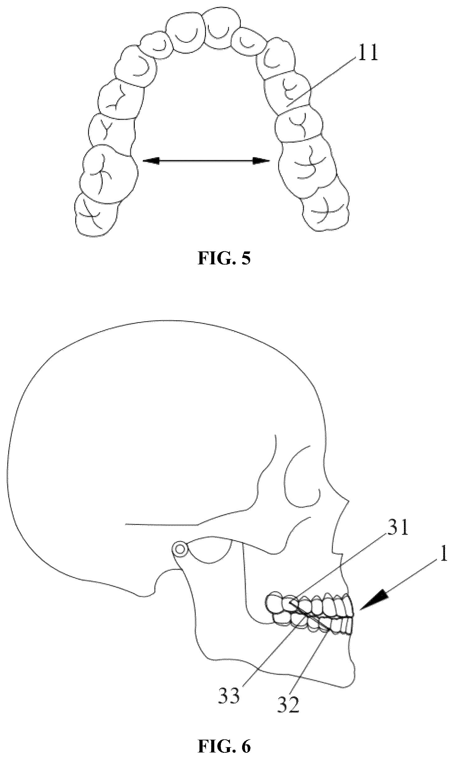 Patent US12318263 Figure 3 – Mandibular positioning facial retrognathism orthodontic system and design method thereof