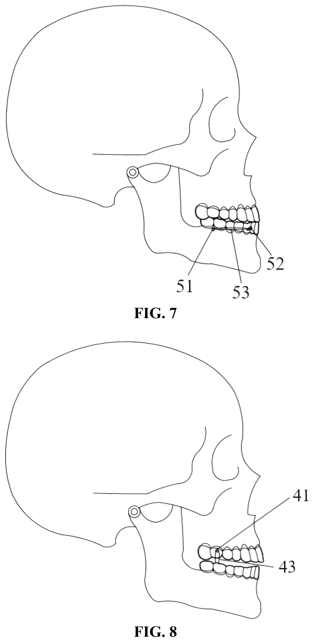 Patent US12318263 Figure 4 – Mandibular positioning facial retrognathism orthodontic system and design method thereof