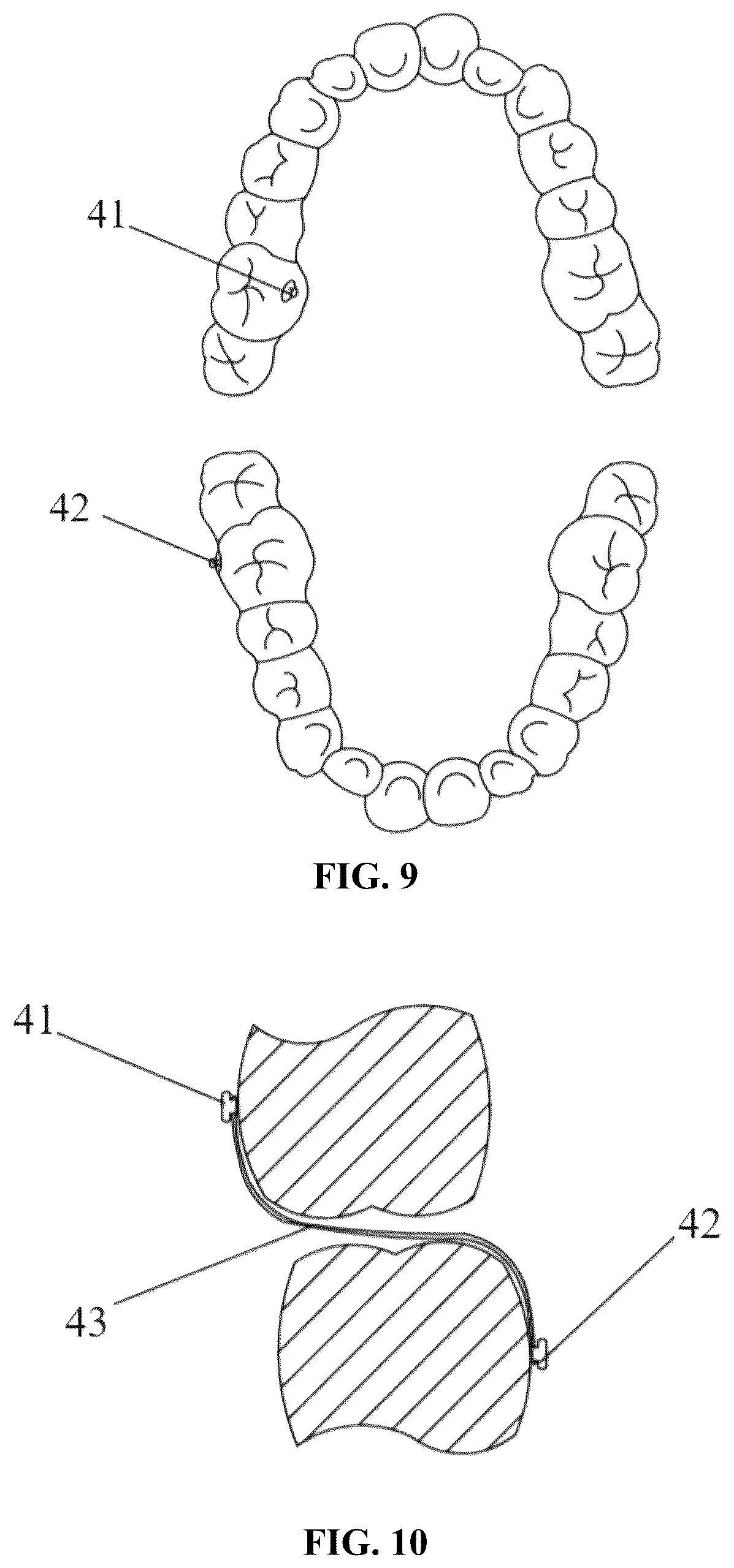 Patent US12318263 Figure 5 – Mandibular positioning facial retrognathism orthodontic system and design method thereof