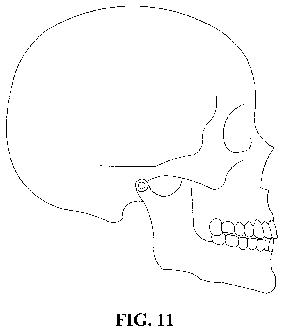 Patent US12318263 Figure 6 – Mandibular positioning facial retrognathism orthodontic system and design method thereof