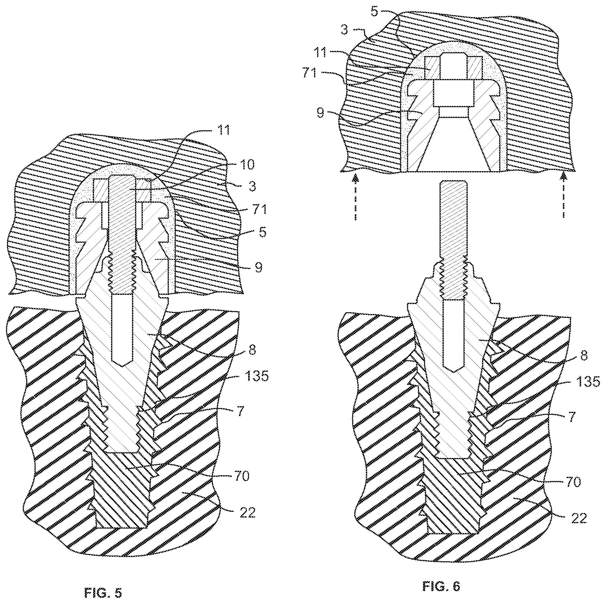 Patent US12318265 Figure 3 – Screw-attached pick-up dental coping system and methods
