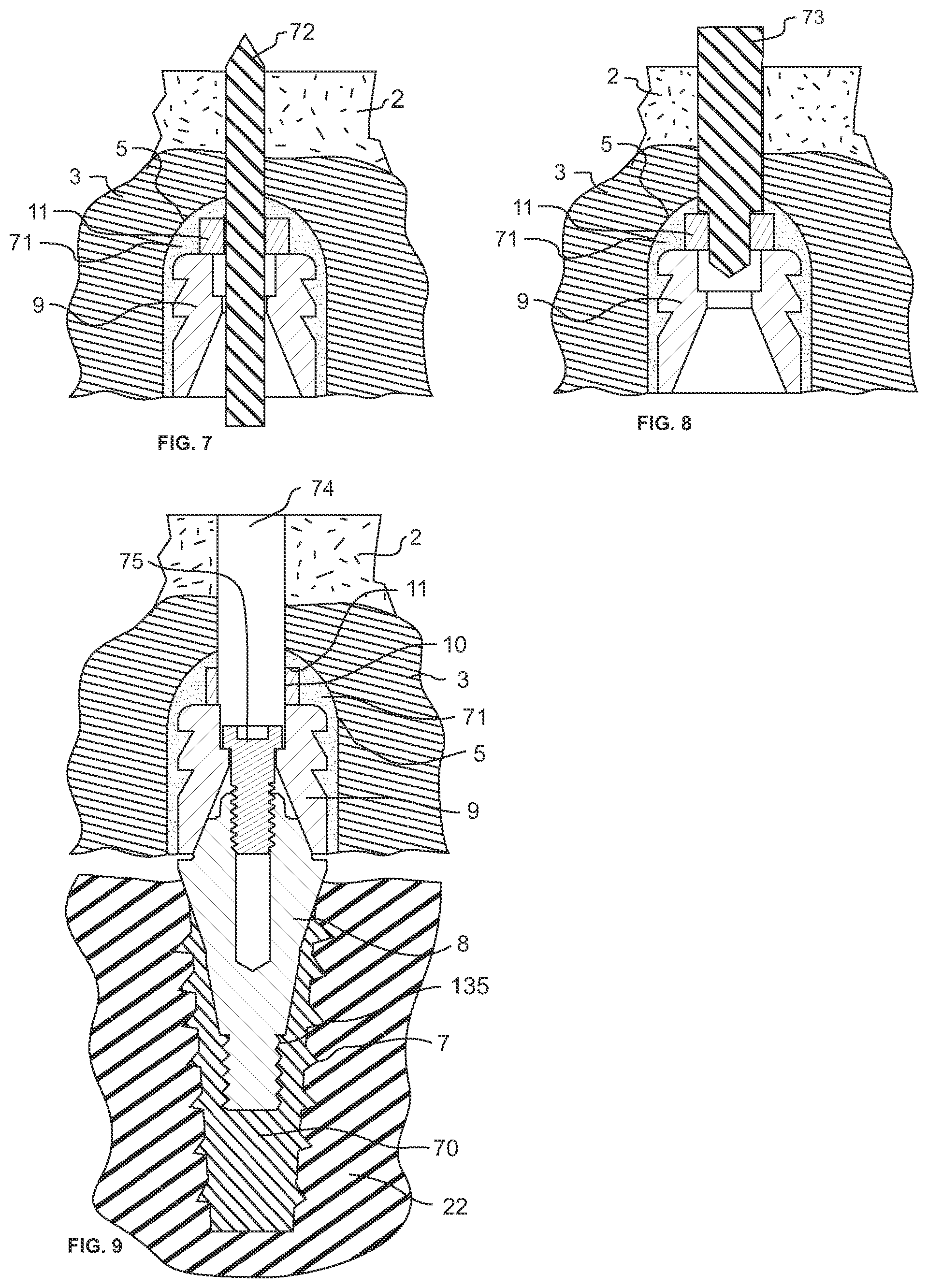 Patent US12318265 Figure 4 – Screw-attached pick-up dental coping system and methods