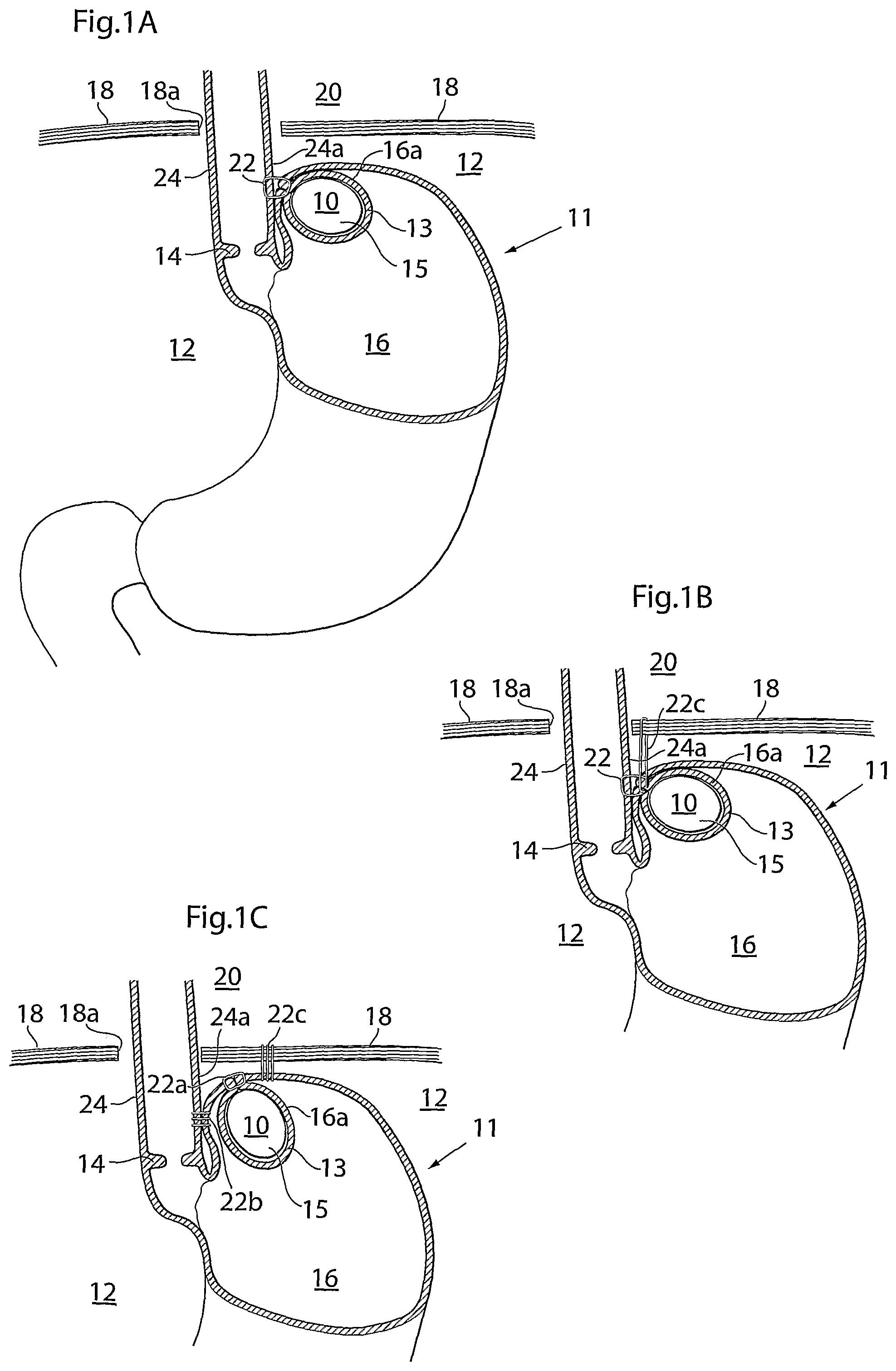 Patent US12318278 Figure 1 – Methods and instruments for treating GERD and hiatal hernia