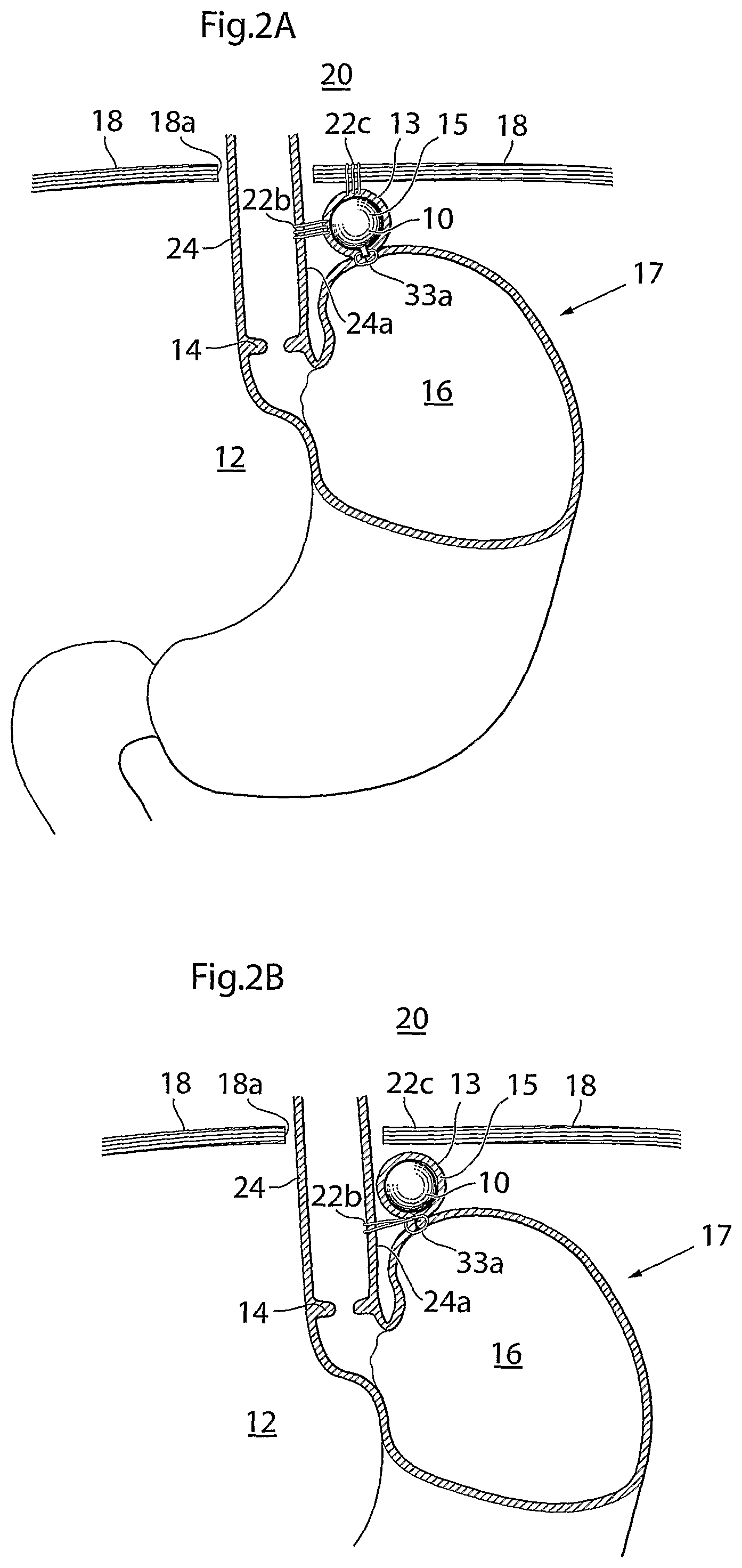 Patent US12318278 Figure 2 – Methods and instruments for treating GERD and hiatal hernia