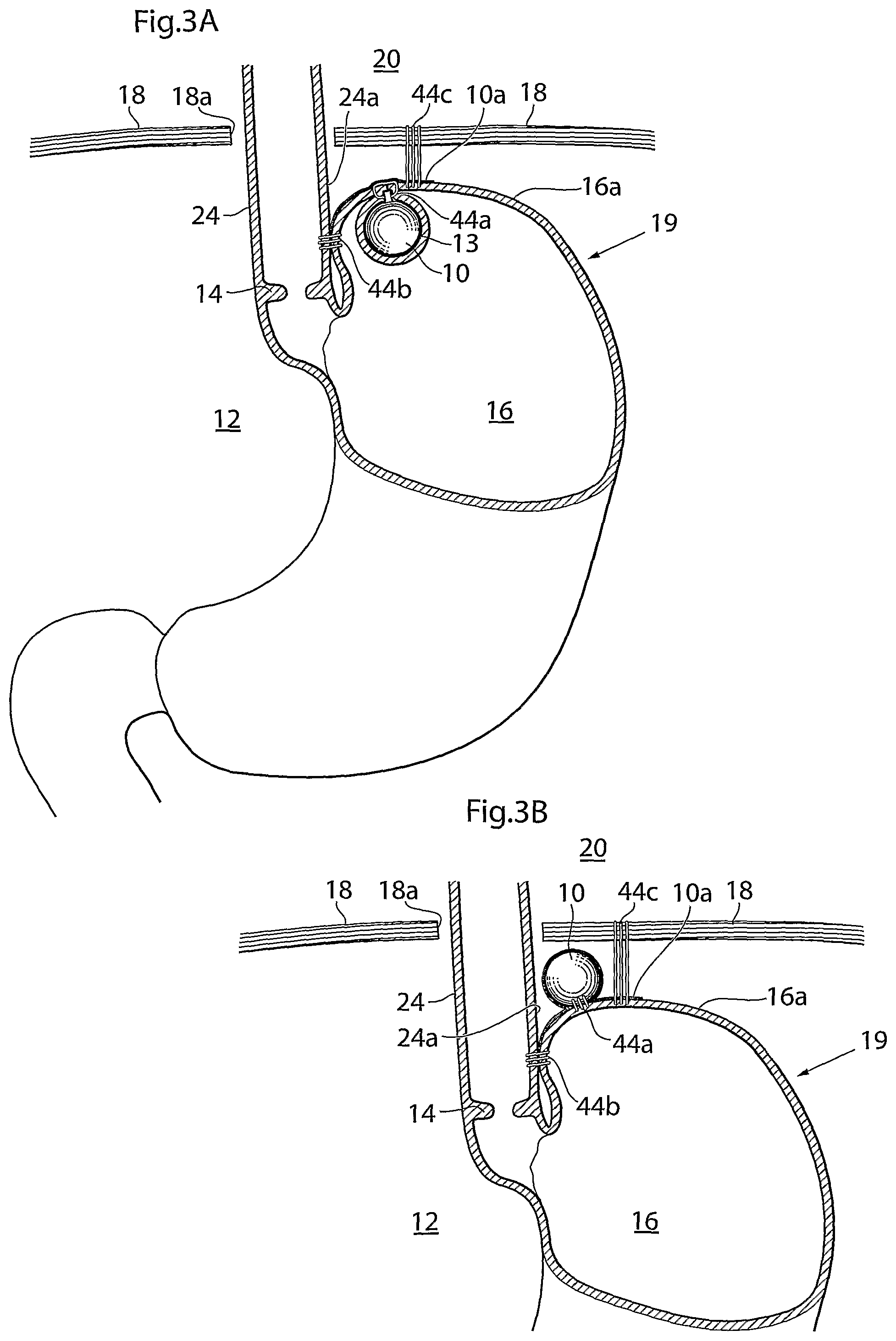 Patent US12318278 Figure 3 – Methods and instruments for treating GERD and hiatal hernia