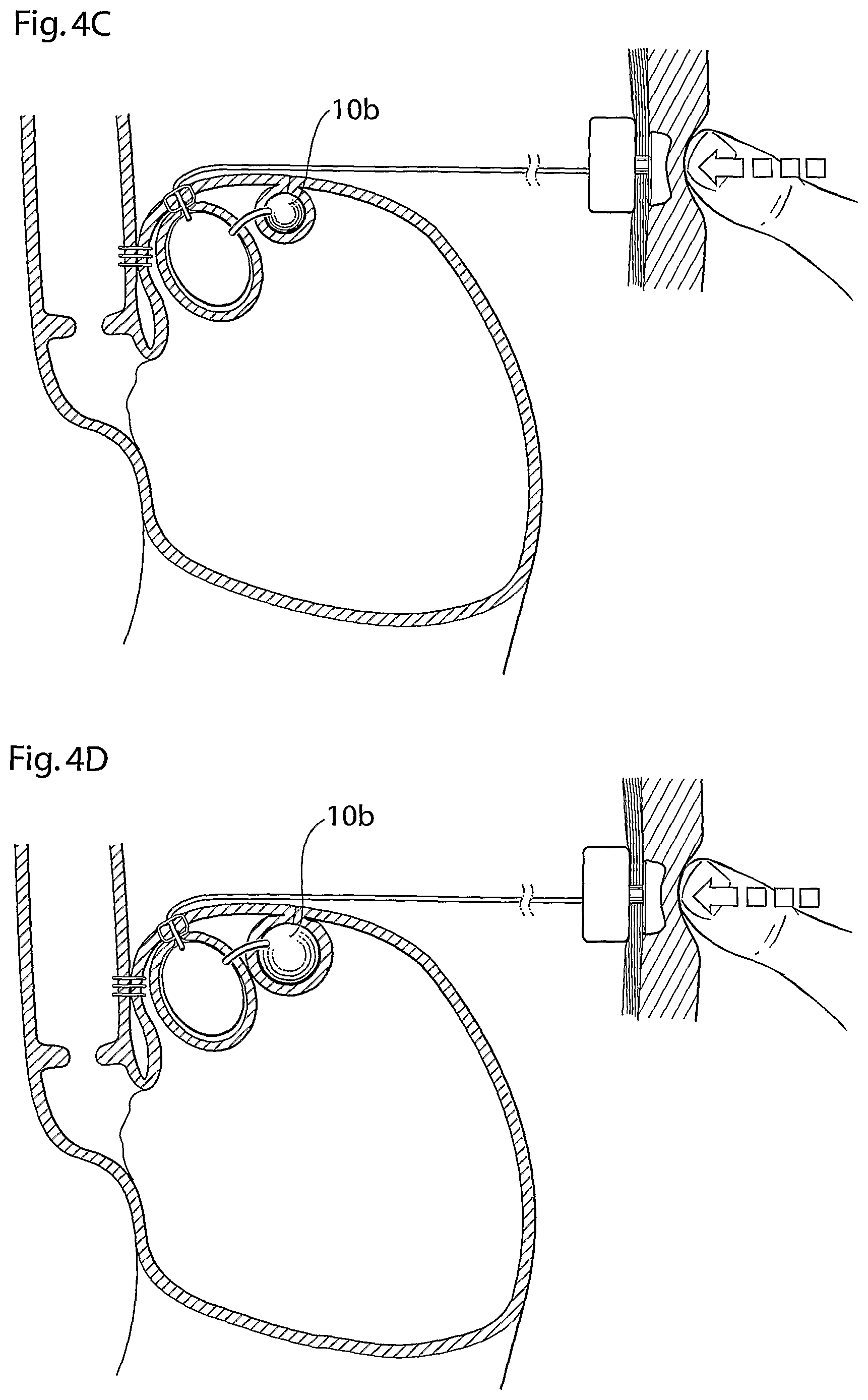 Patent US12318278 Figure 5 – Methods and instruments for treating GERD and hiatal hernia