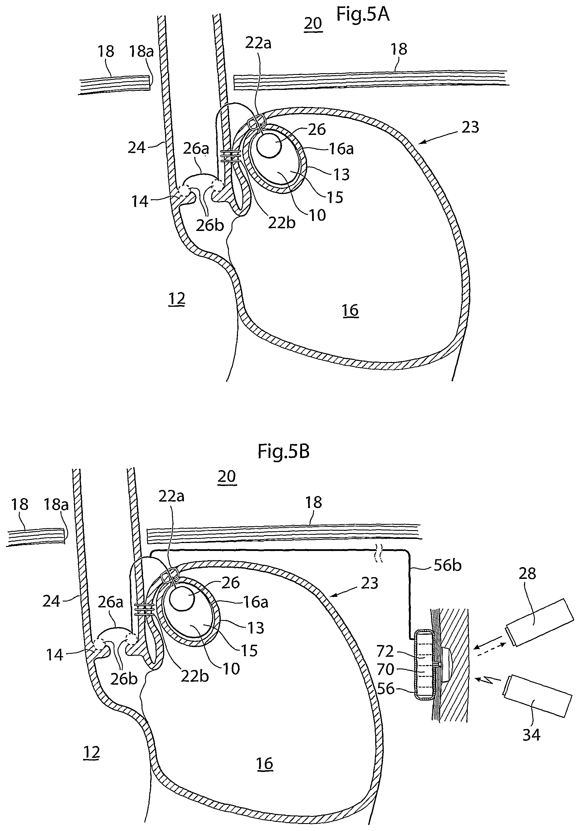Patent US12318278 Figure 6 – Methods and instruments for treating GERD and hiatal hernia