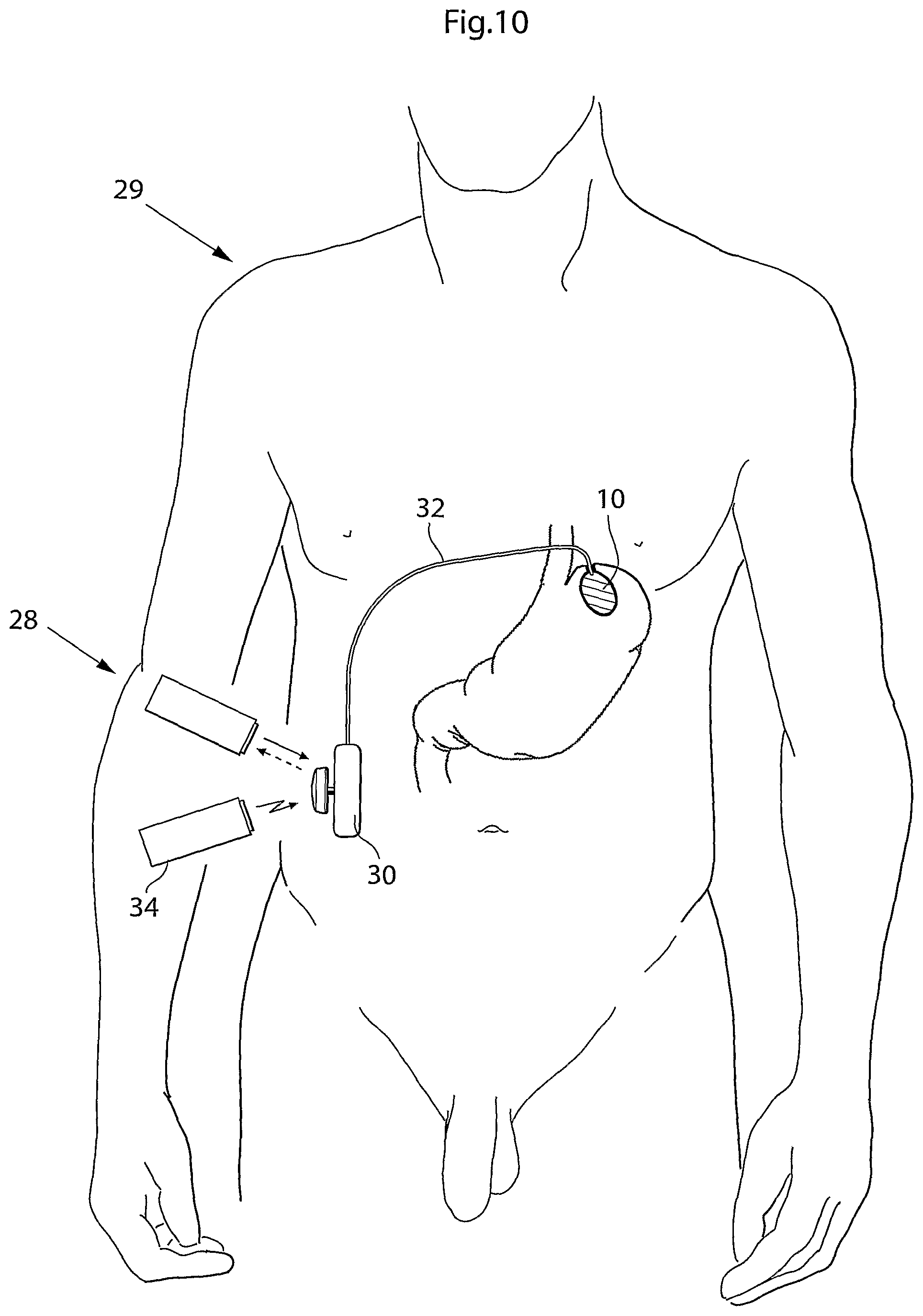 Patent US12318278 Figure 8 – Methods and instruments for treating GERD and hiatal hernia