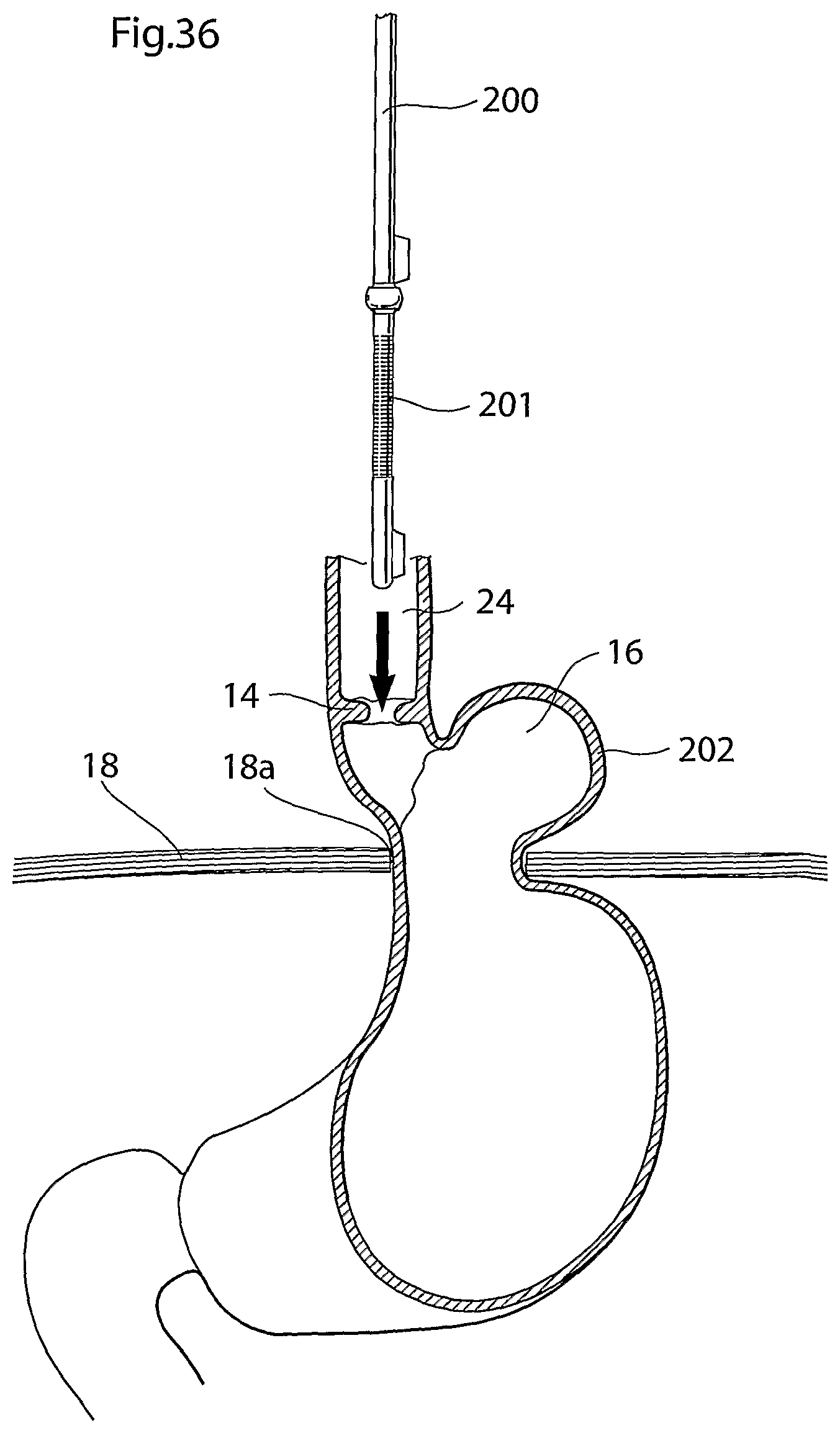 Patent US12318278 Figure 18 – Methods and instruments for treating GERD and hiatal hernia