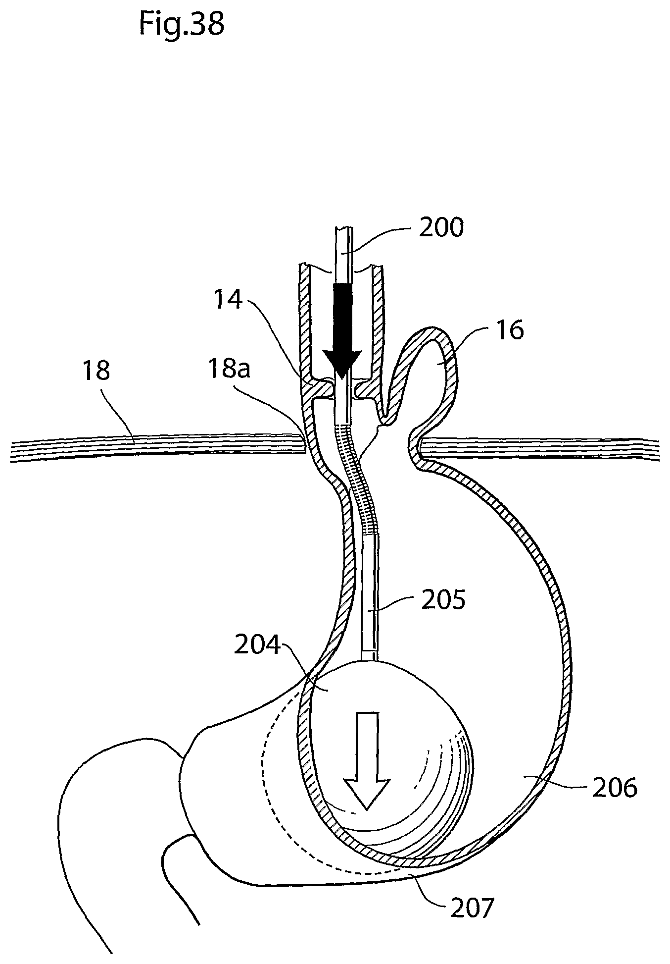 Patent US12318278 Figure 20 – Methods and instruments for treating GERD and hiatal hernia