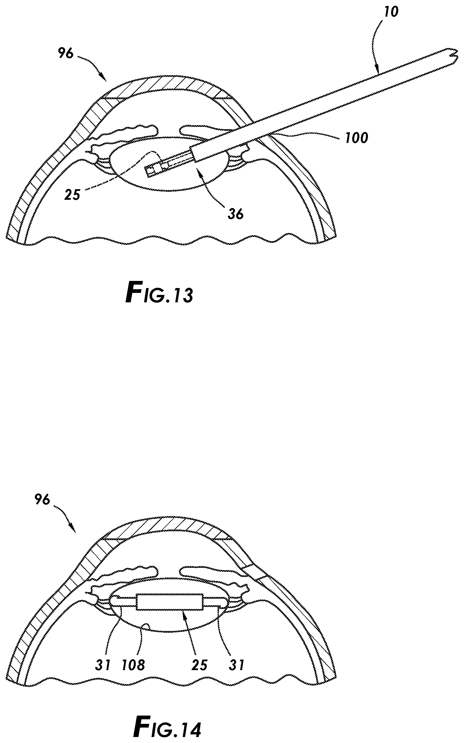 Patent US12318280 Figure 9 – Removable cap actuation for an intraocular lens cartridge