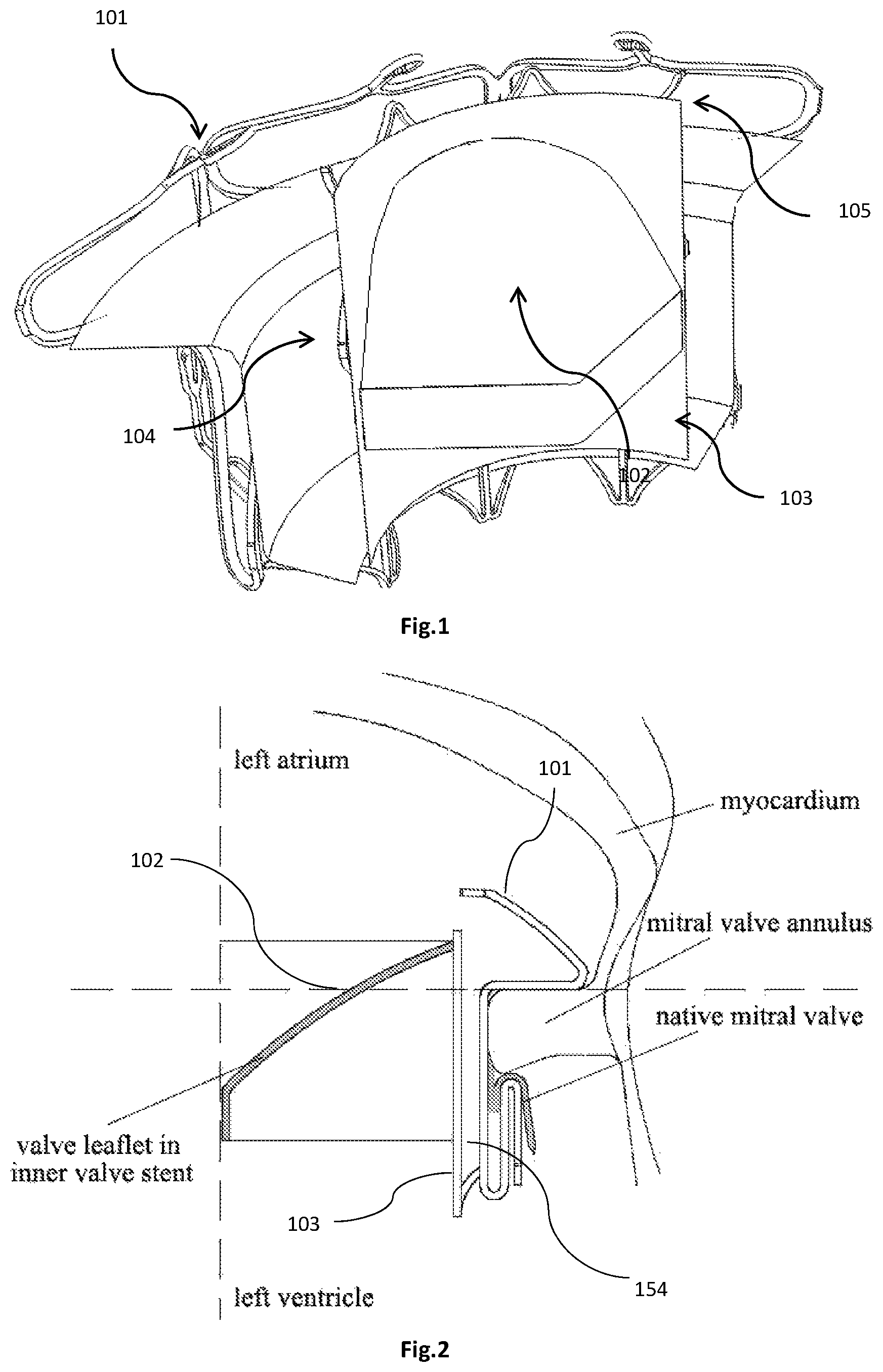 Patent US12318282 Figure 1 – Transapical implantable mitral valve device