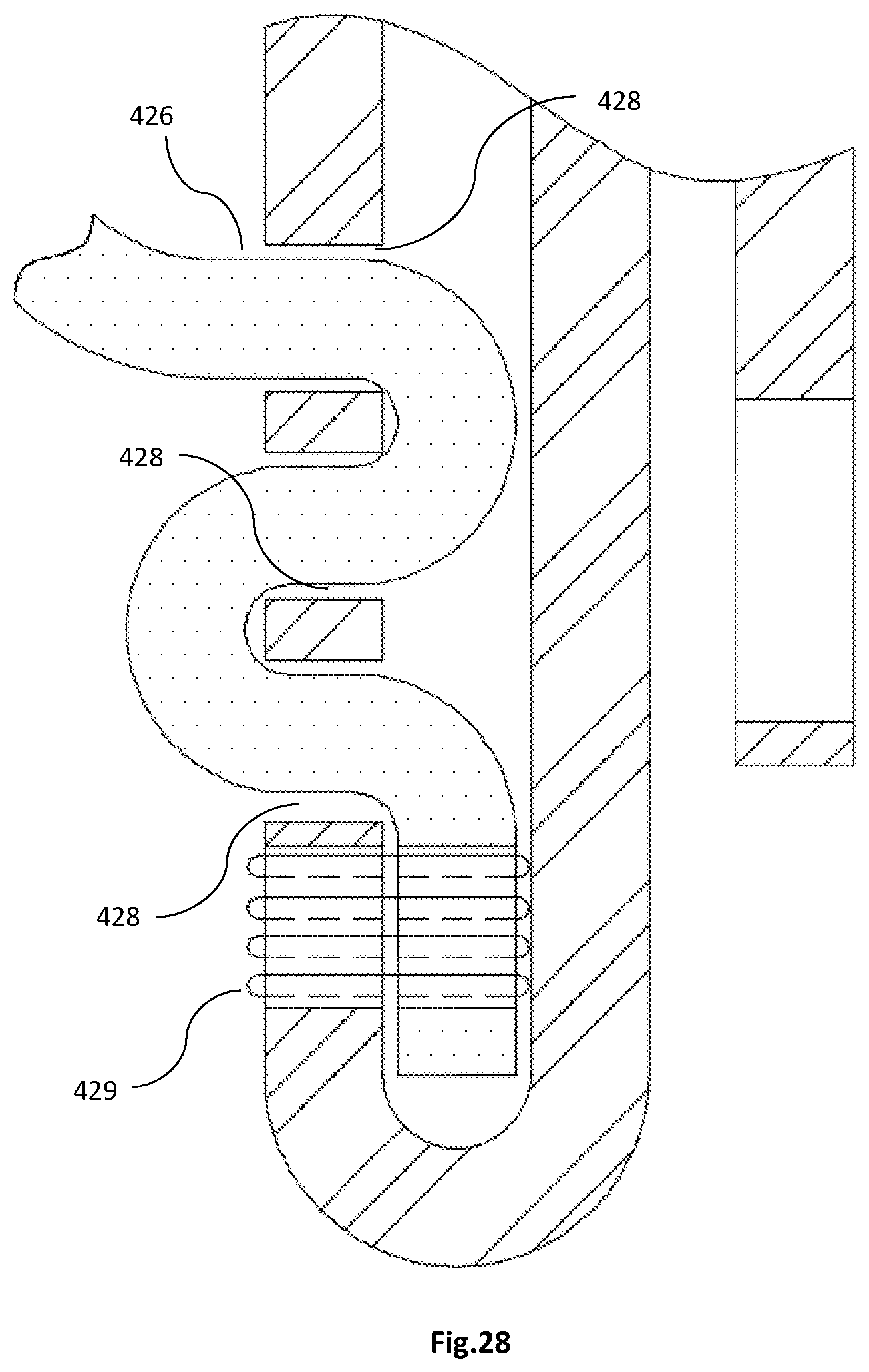 Patent US12318282 Figure 18 – Transapical implantable mitral valve device