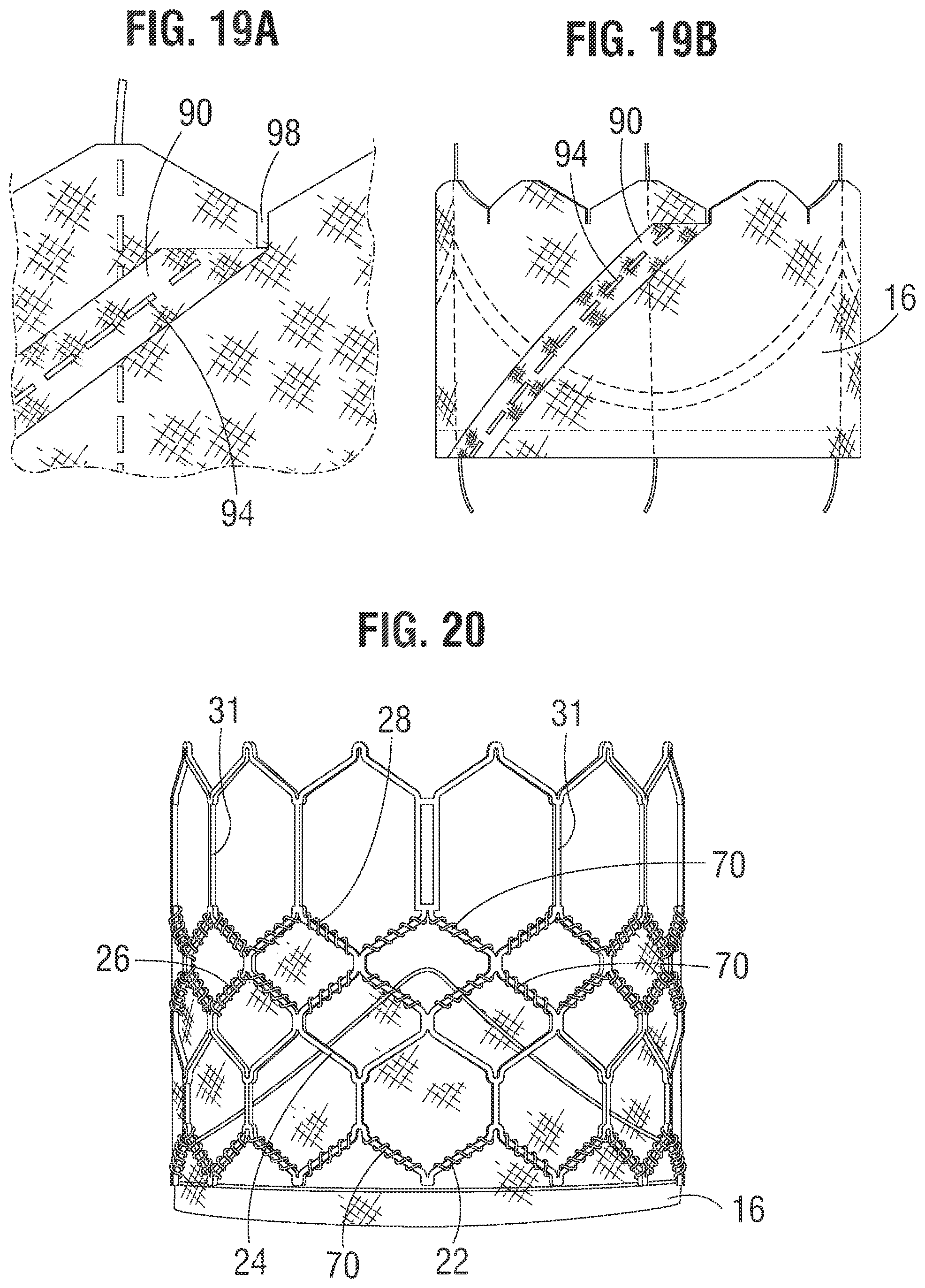 Patent US12318283 Figure 6 – Prosthetic heart valve