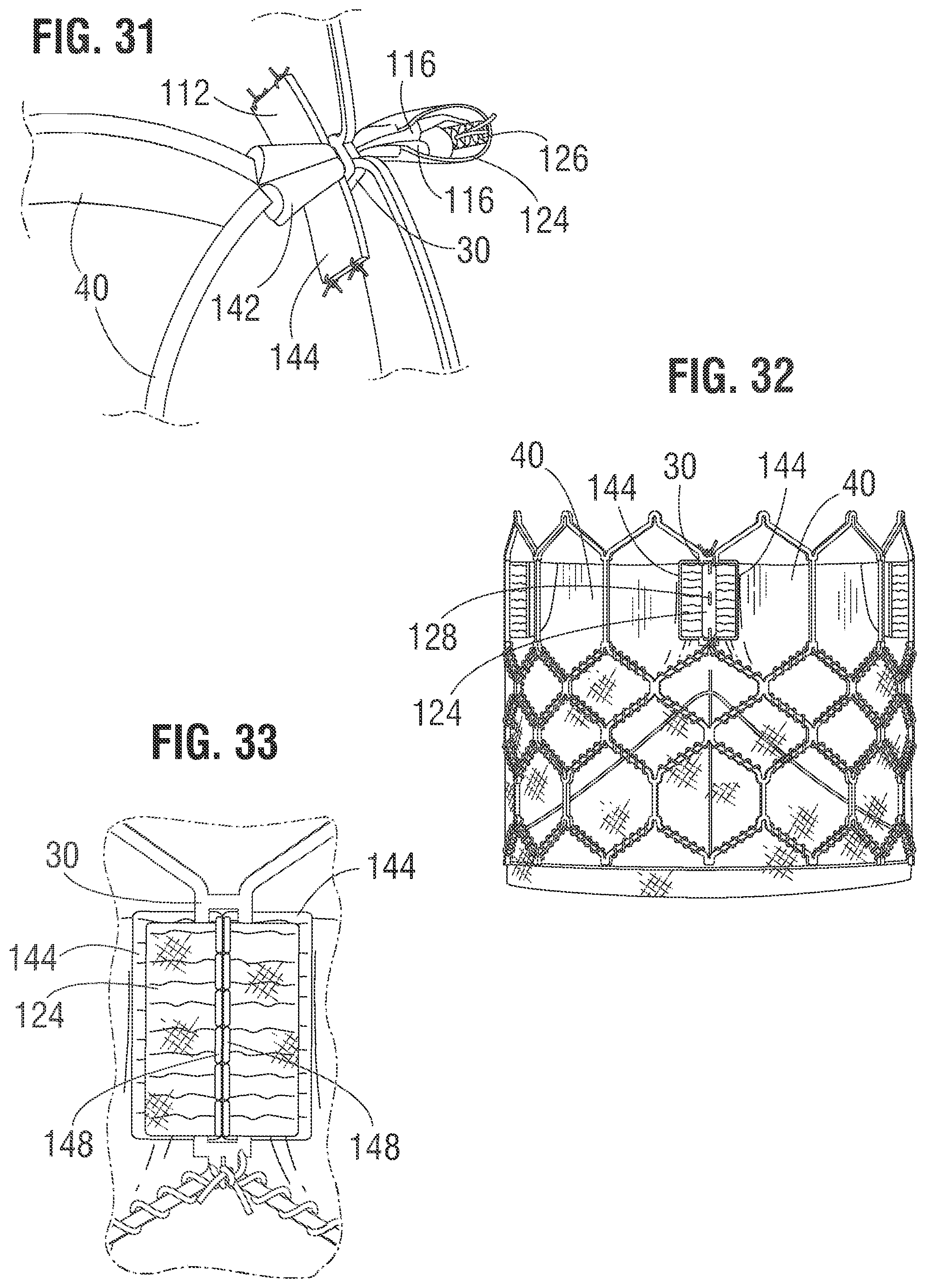 Patent US12318283 Figure 11 – Prosthetic heart valve