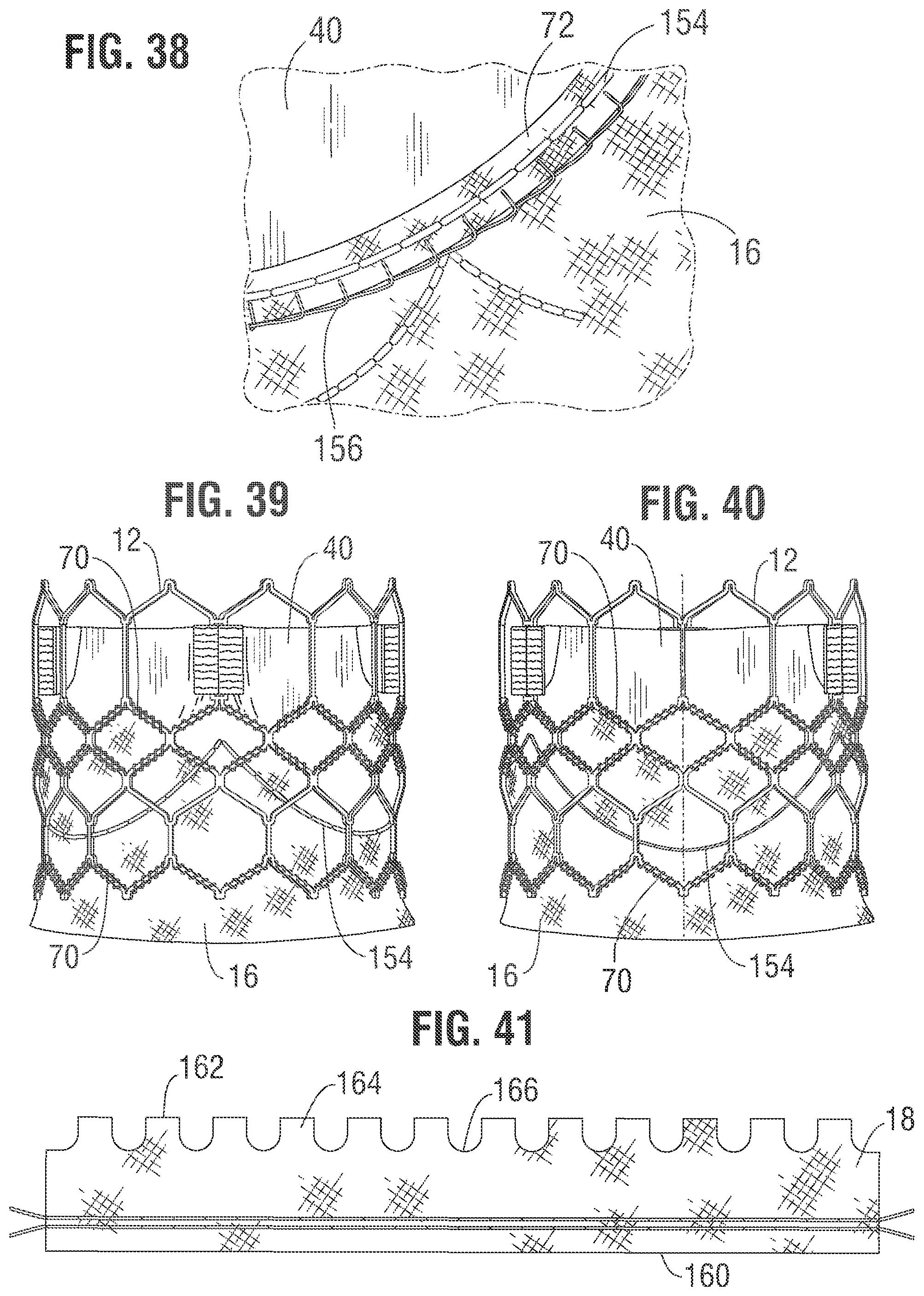 Patent US12318283 Figure 14 – Prosthetic heart valve