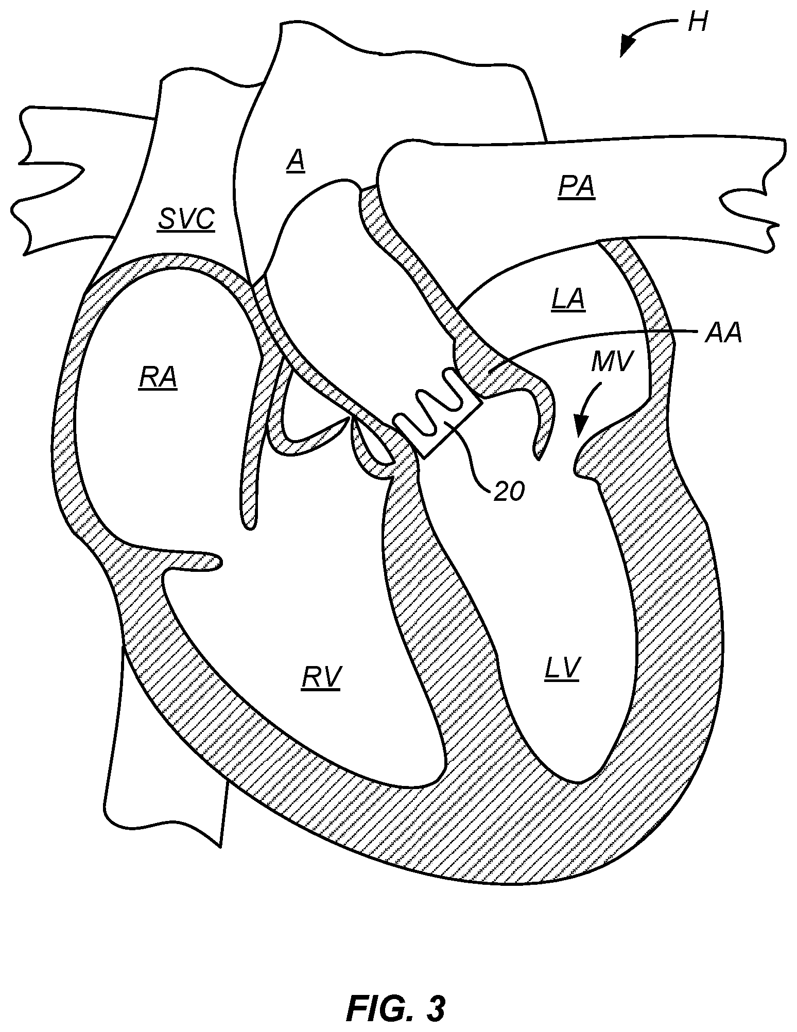 Patent US12318284 Figure 3 – Endovascular prosthetic heart valve replacement
