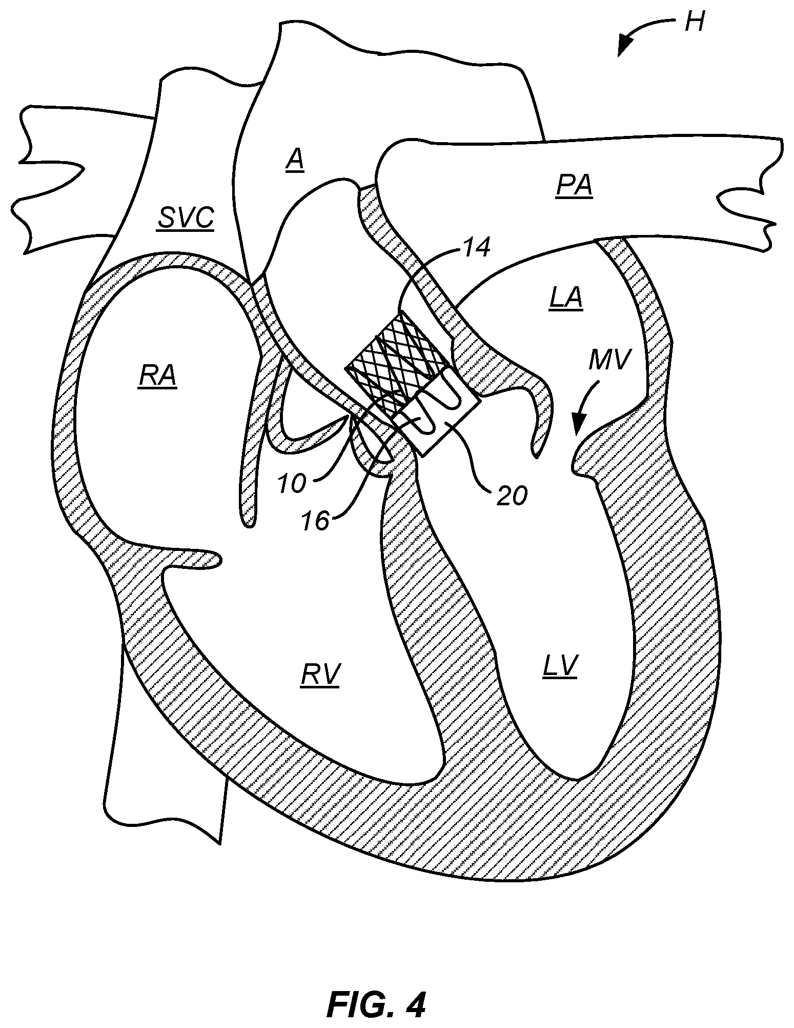Patent US12318284 Figure 4 – Endovascular prosthetic heart valve replacement